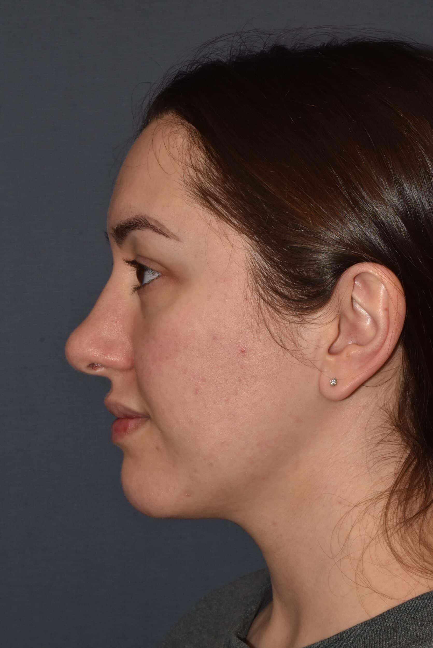 Before Image: Rhinoplasty – Open - left-side