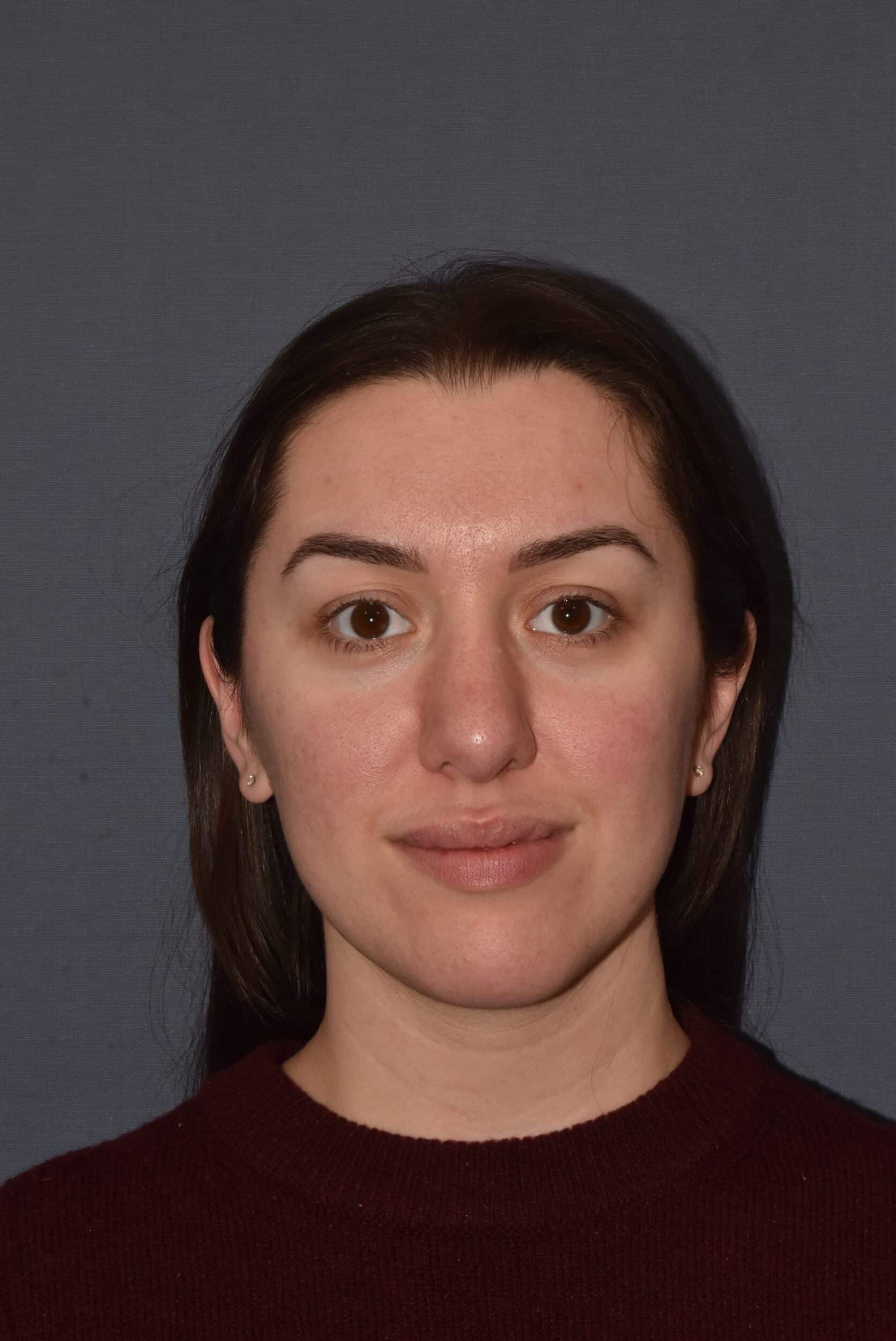 After Image: Rhinoplasty – Open - front