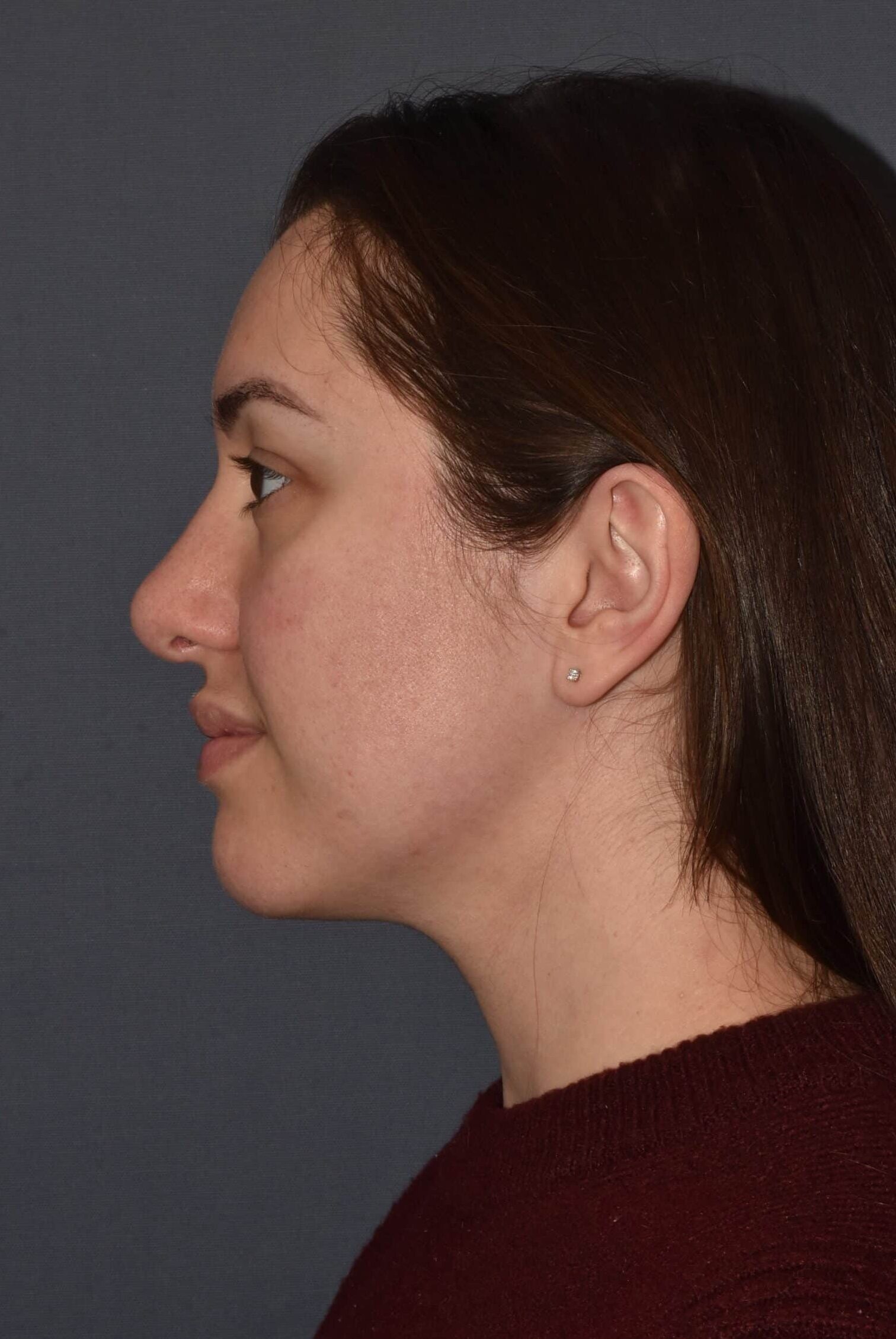 After Image: Rhinoplasty – Open - left-side