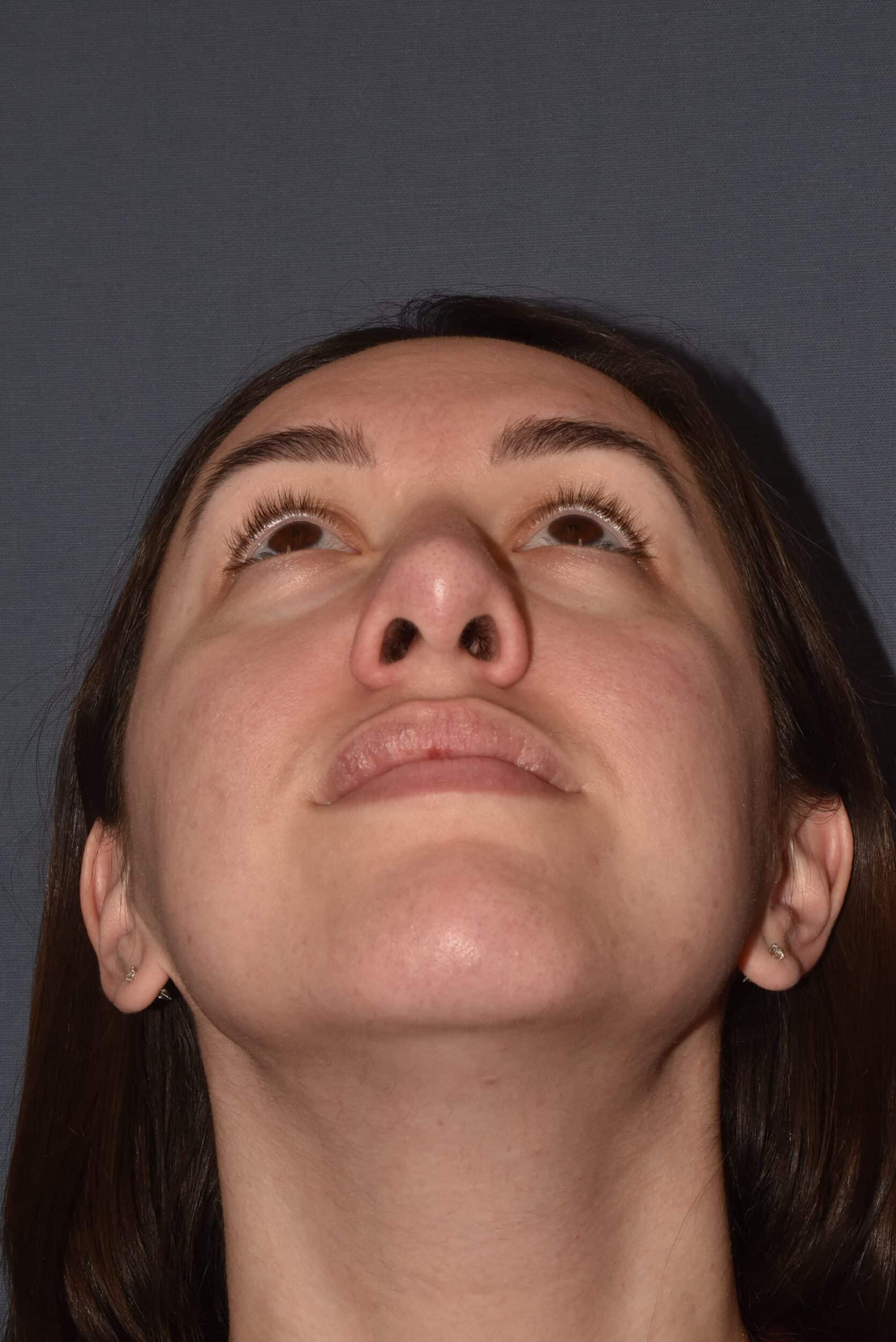 After Image: Rhinoplasty – Open - other