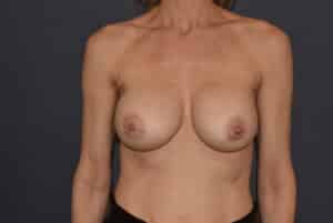 Breast Augmentation Revision With DuraSorb Mesh