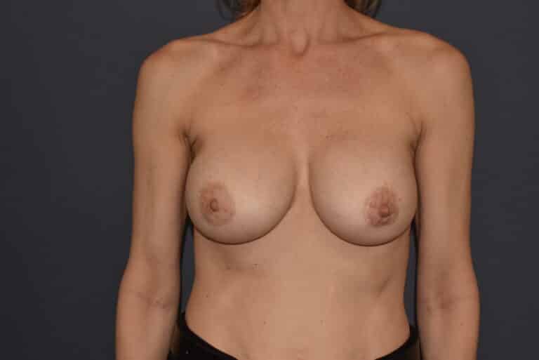 After Image: Breast Augmentation Revision With DuraSorb Mesh - front