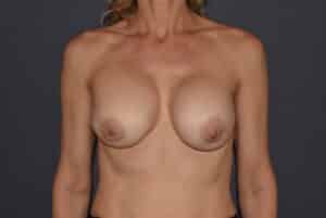 Before Image: Breast Augmentation Revision With DuraSorb Mesh