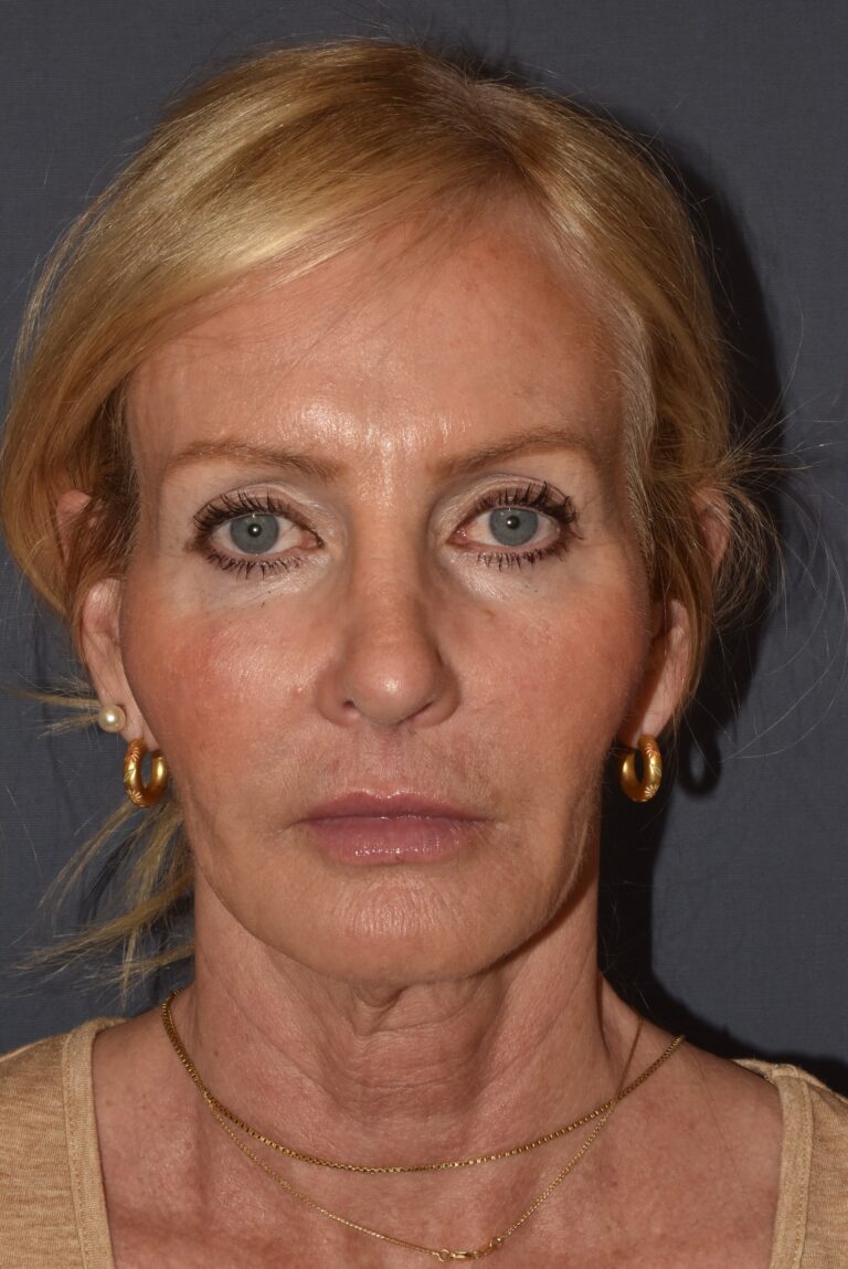 After Image: Rhinoplasty – Open - front