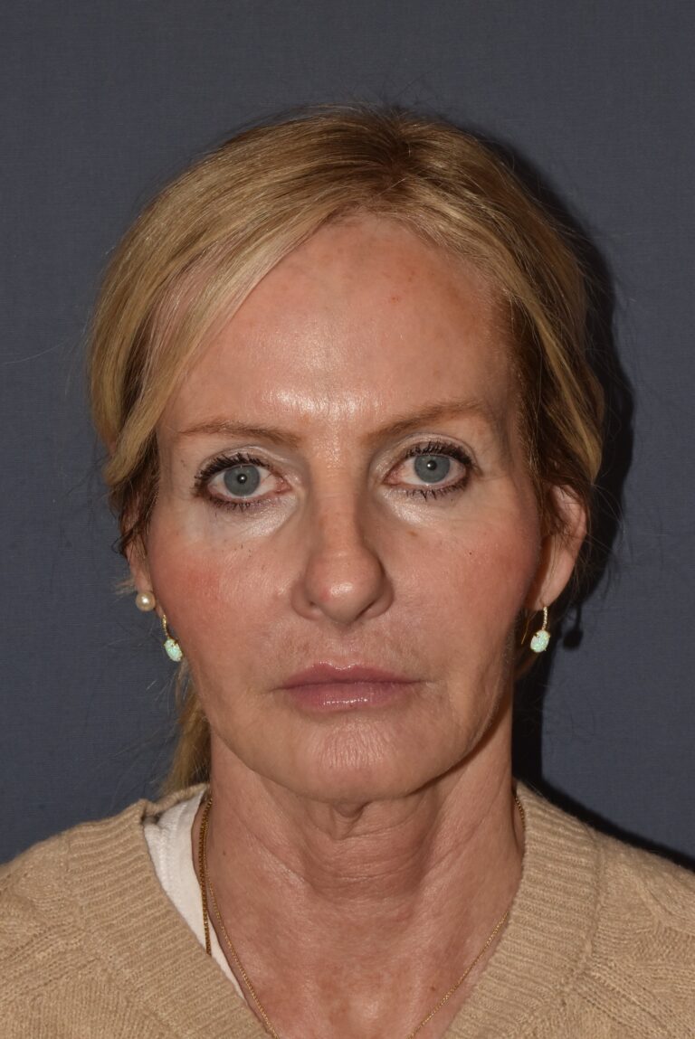 Before Image: Rhinoplasty – Open - front