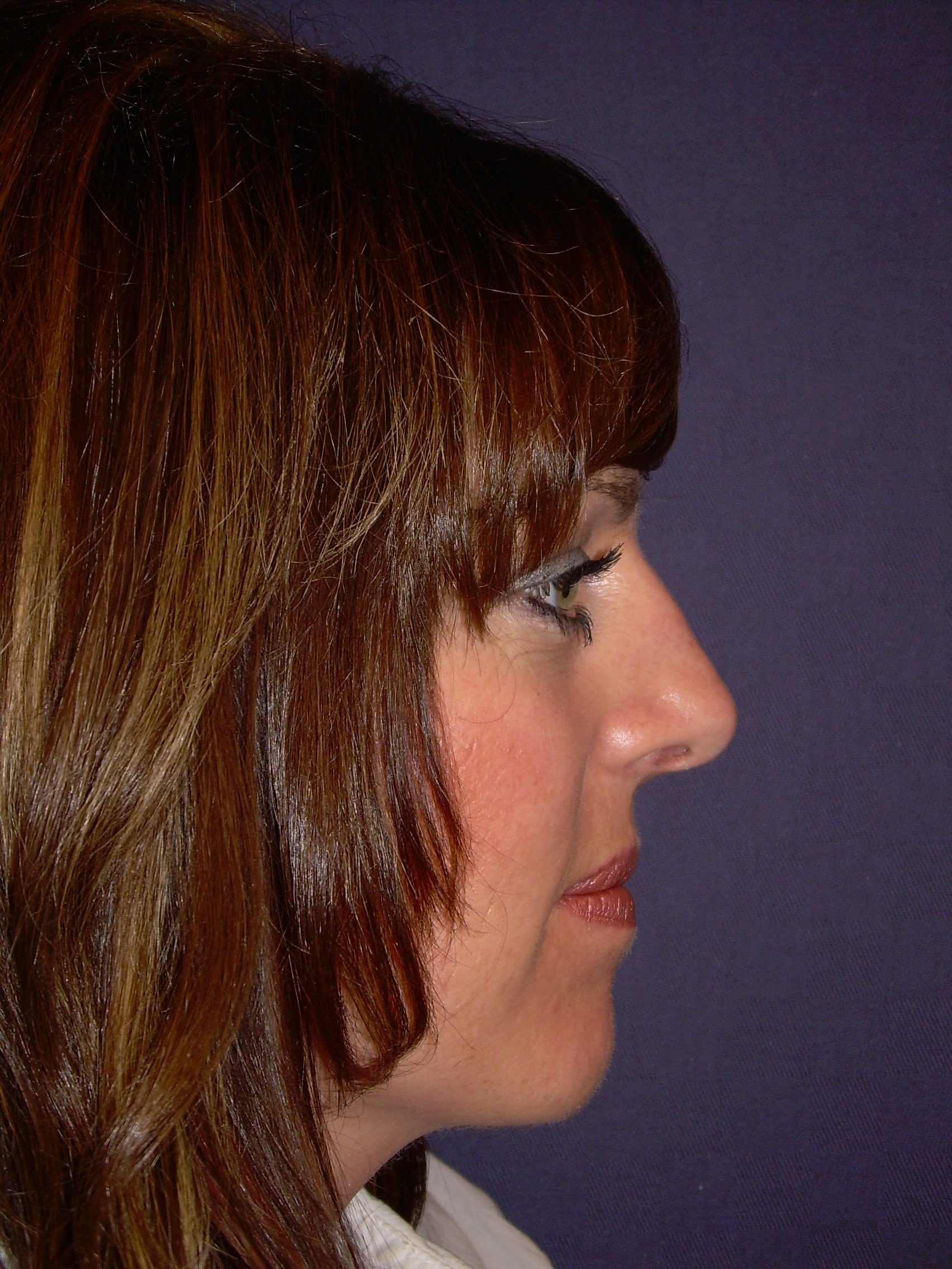 Before Image: Rhinoplasty – Open - right-side