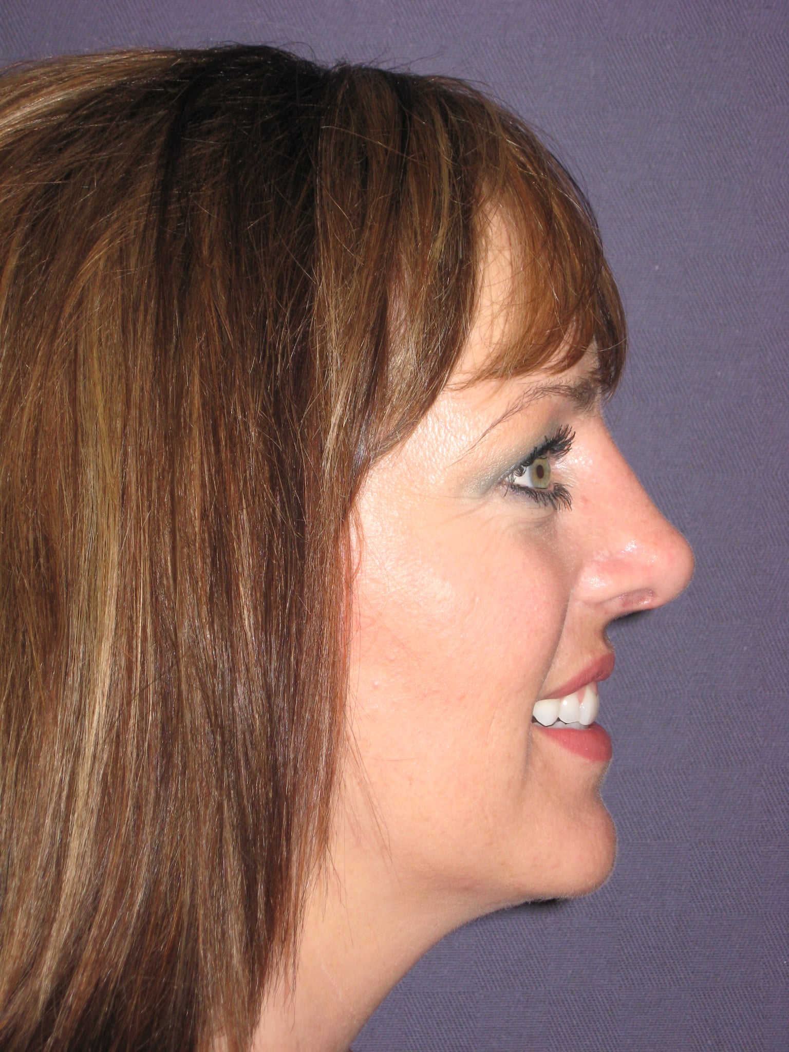 After Image: Rhinoplasty – Open - right-side