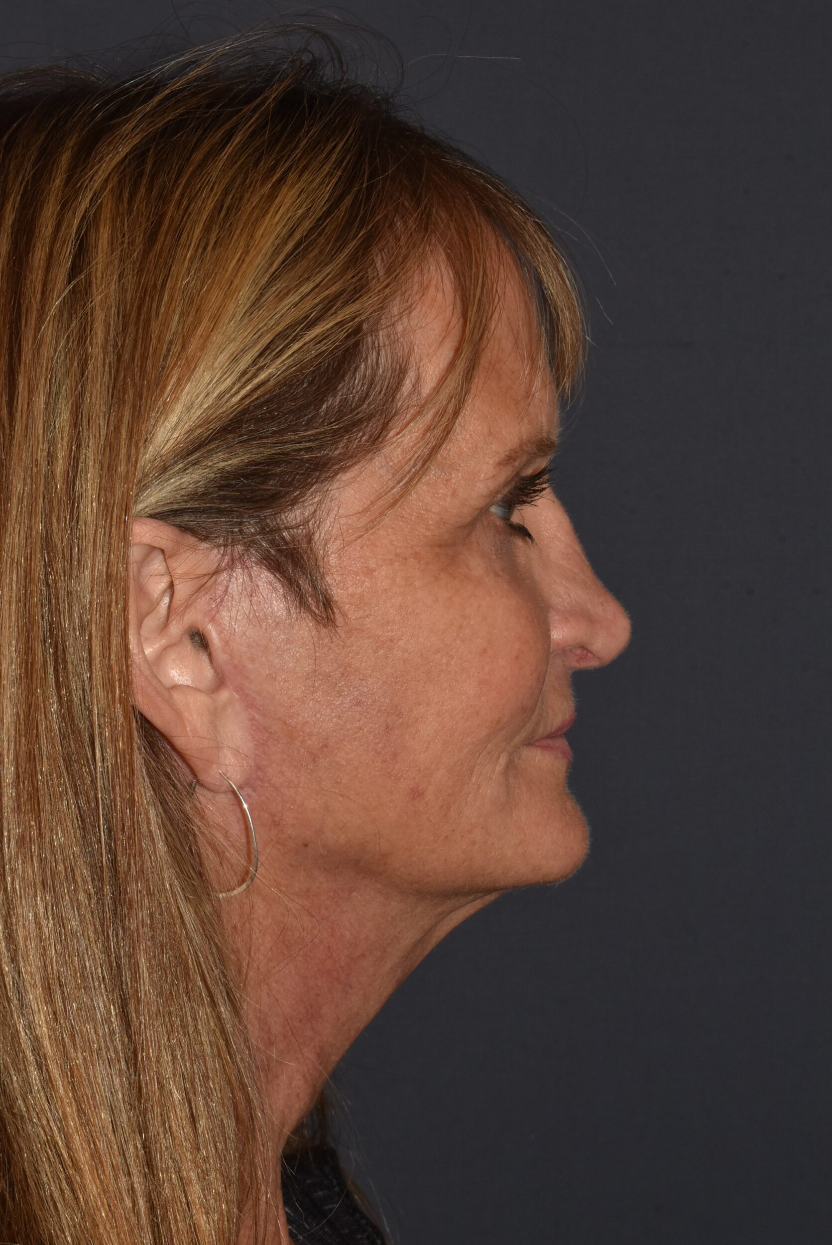 After Image: Rhinoplasty – Open Revision with Banked Cartilage - right-side