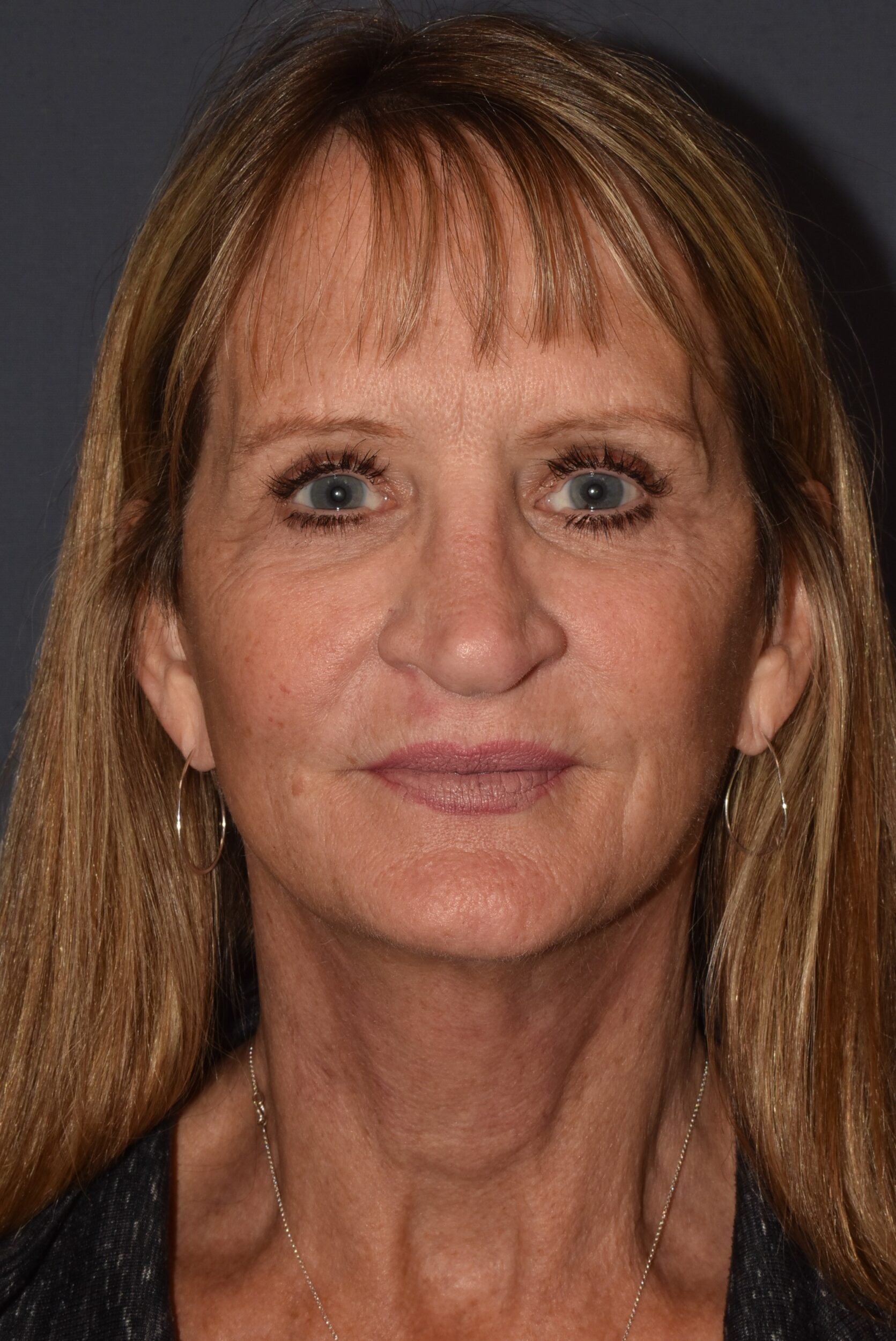 After Image: Rhinoplasty – Open Revision with Banked Cartilage - front