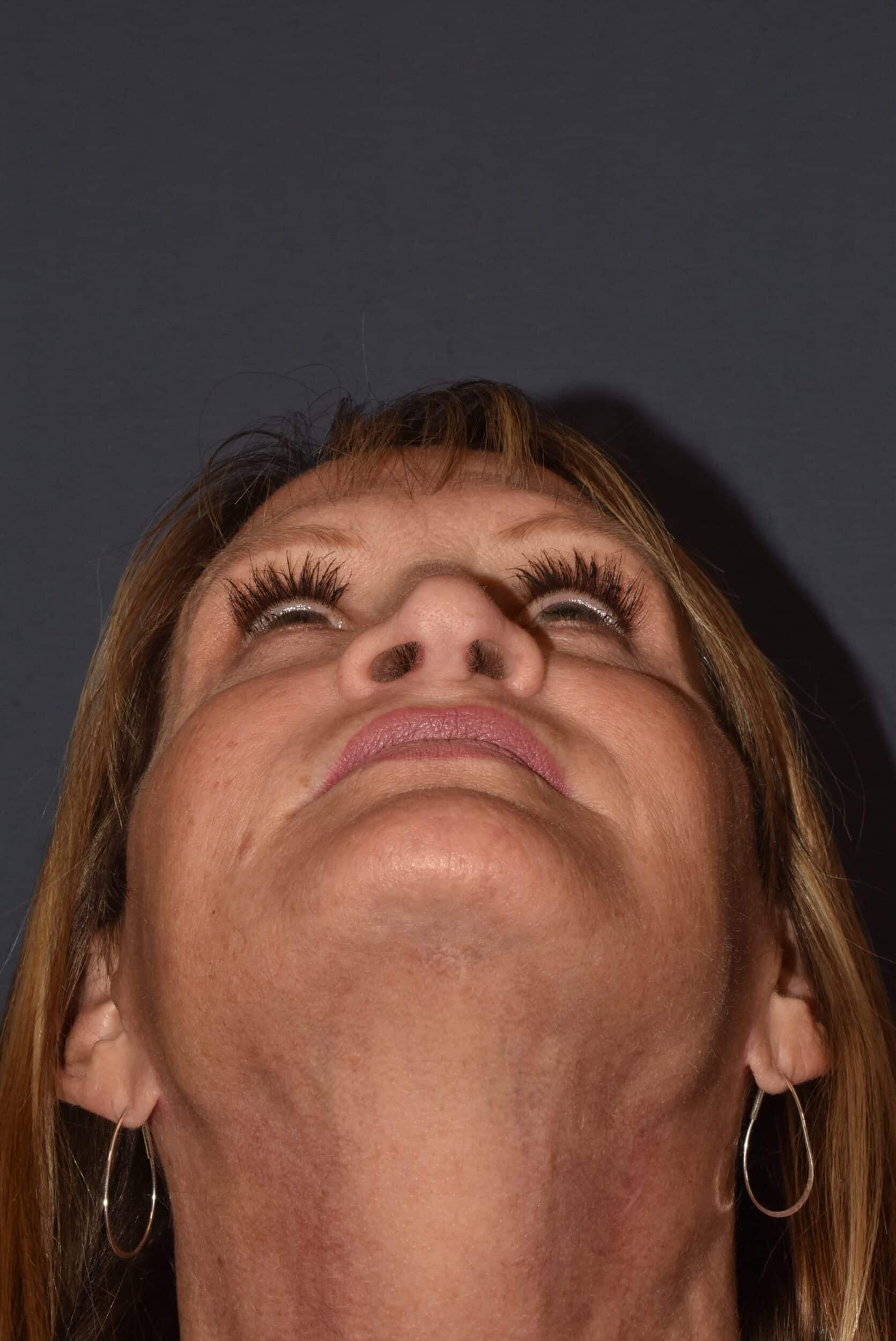 After Image: Rhinoplasty – Open Revision with Banked Cartilage - other