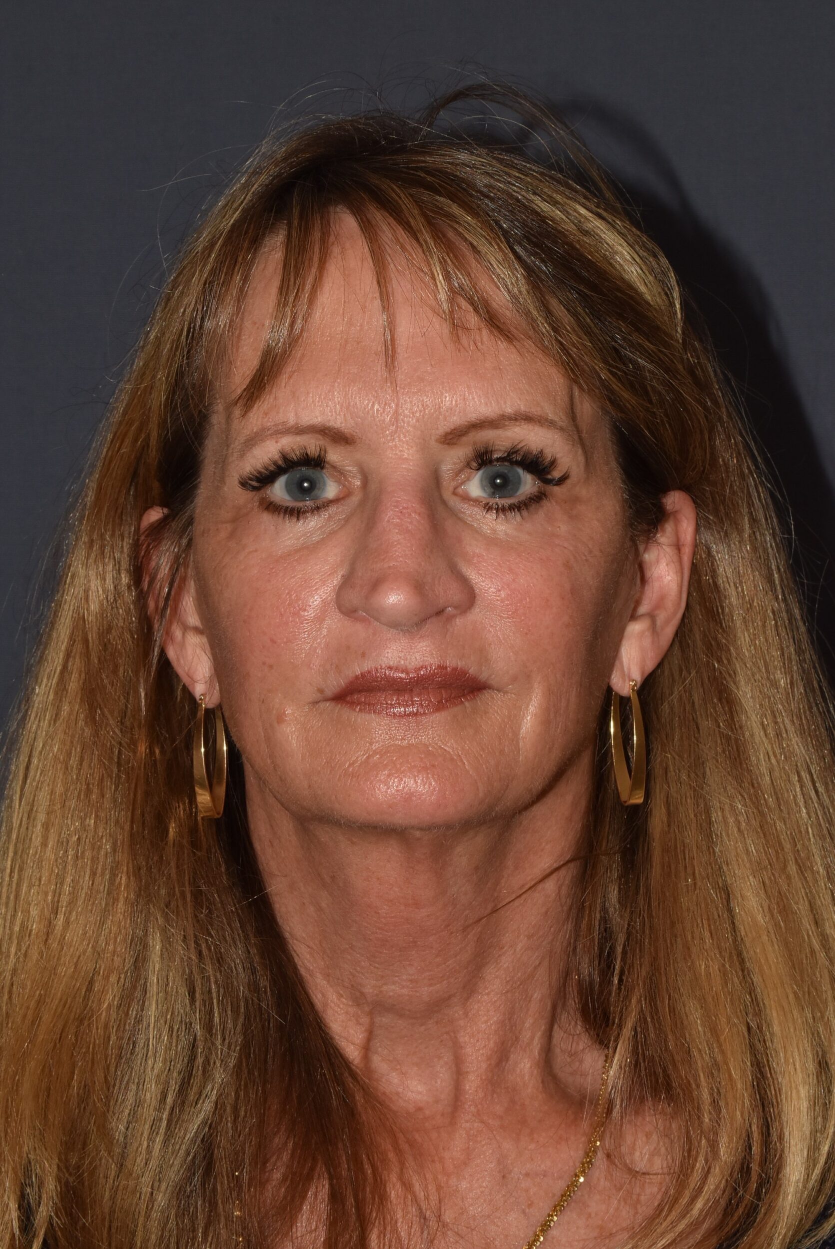Before Image: Rhinoplasty – Open Revision with Banked Cartilage - front