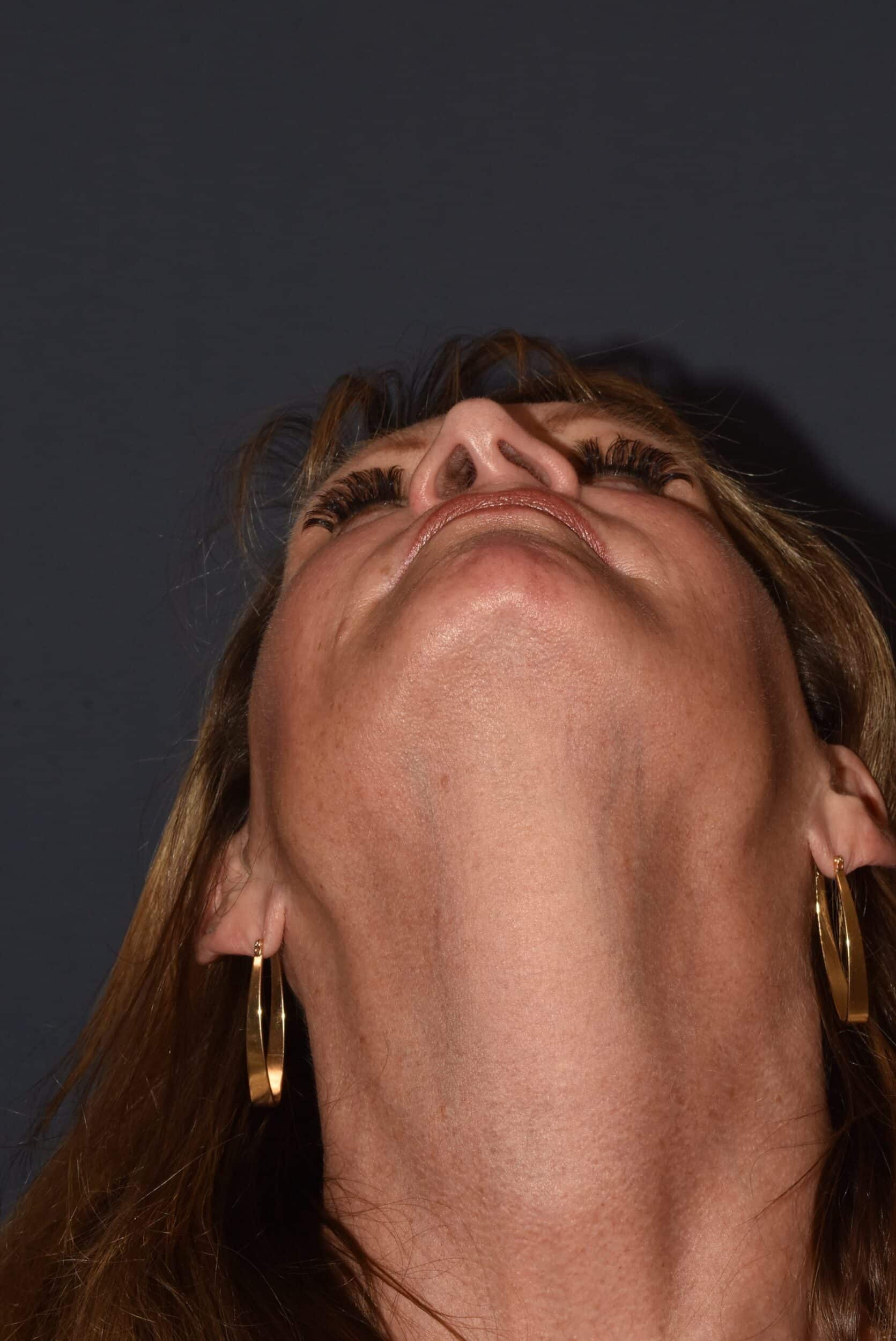 Before Image: Rhinoplasty – Open Revision with Banked Cartilage - other