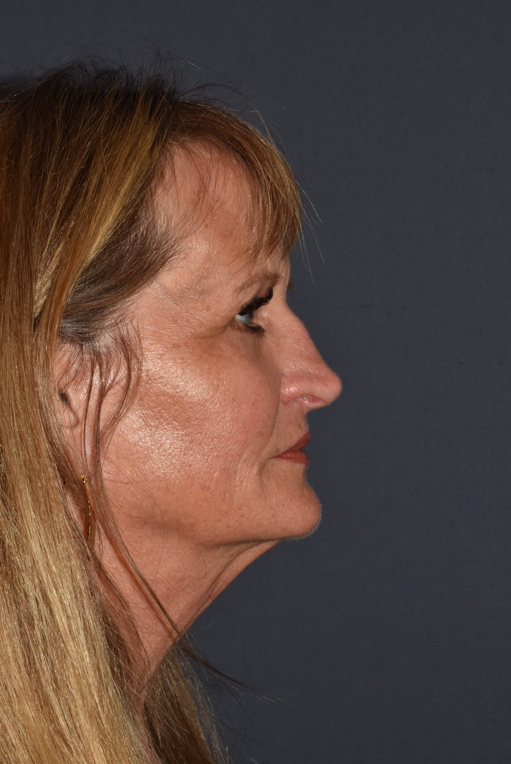 Before Image: Rhinoplasty – Open Revision with Banked Cartilage - right-side