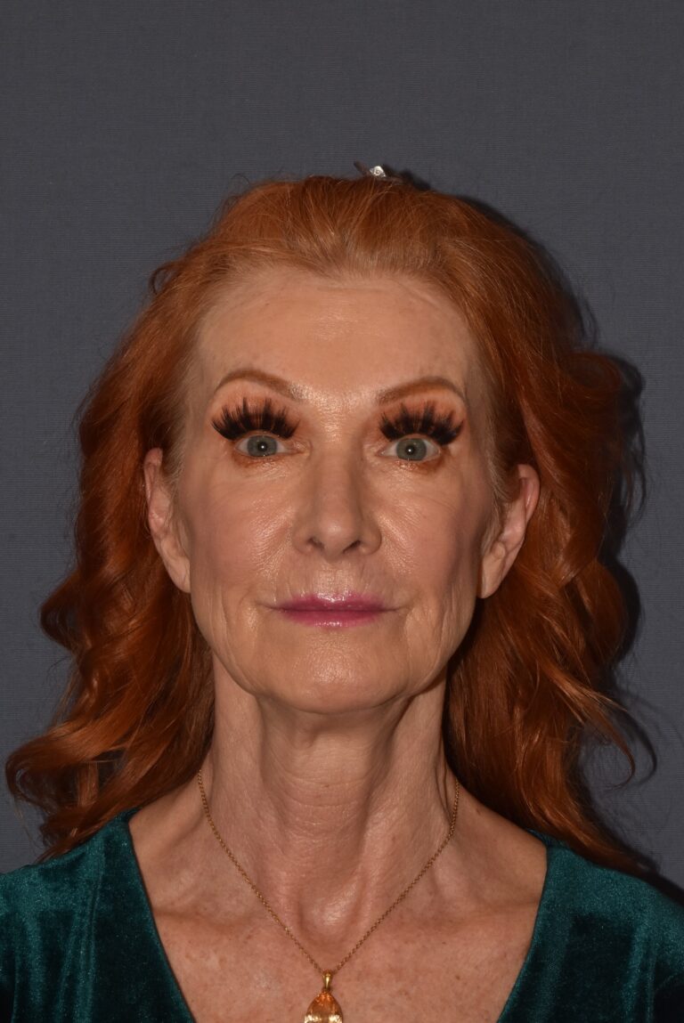 Before Image: Facial Rejuvenation – Lower Facelift / Neck Lift with Chin Implant - front