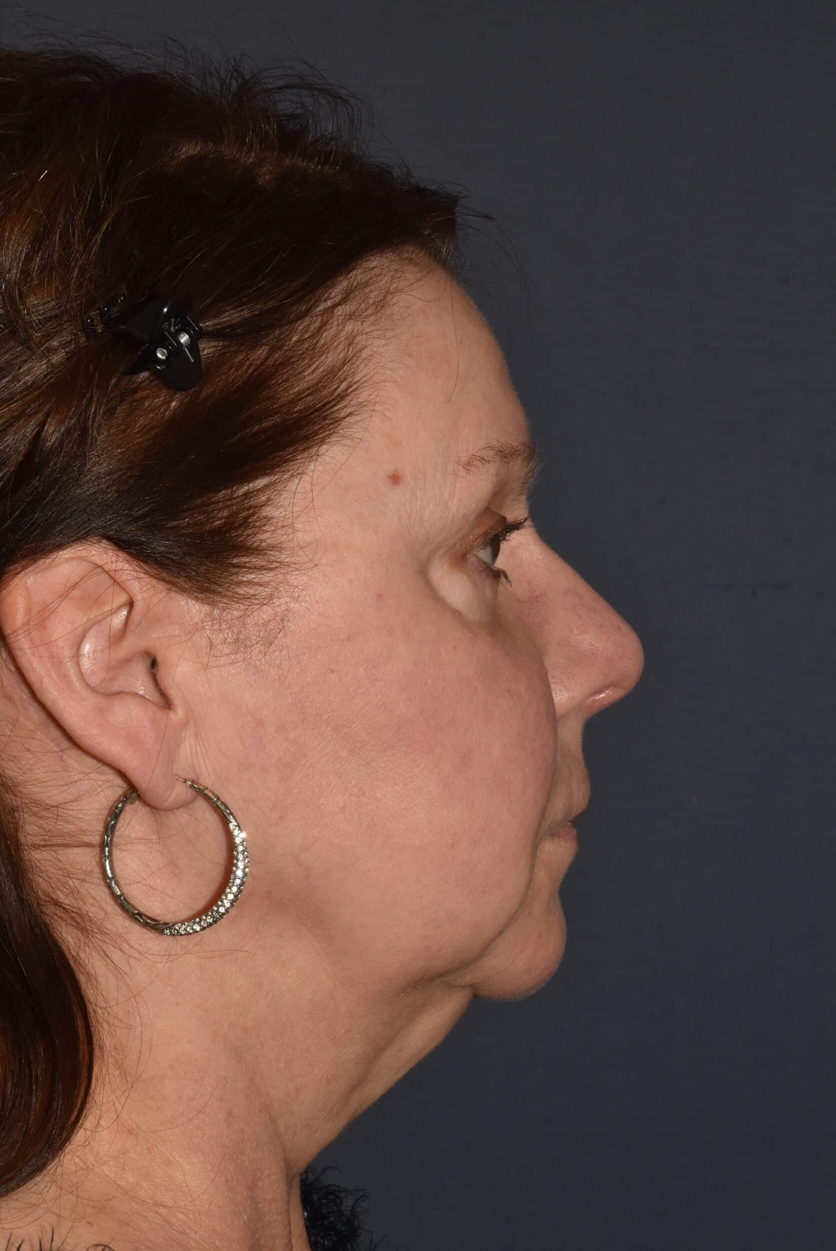 Before Image: Facial Rejuvenation – Lower Facelift / Neck Lift with Chin Implant - right-side