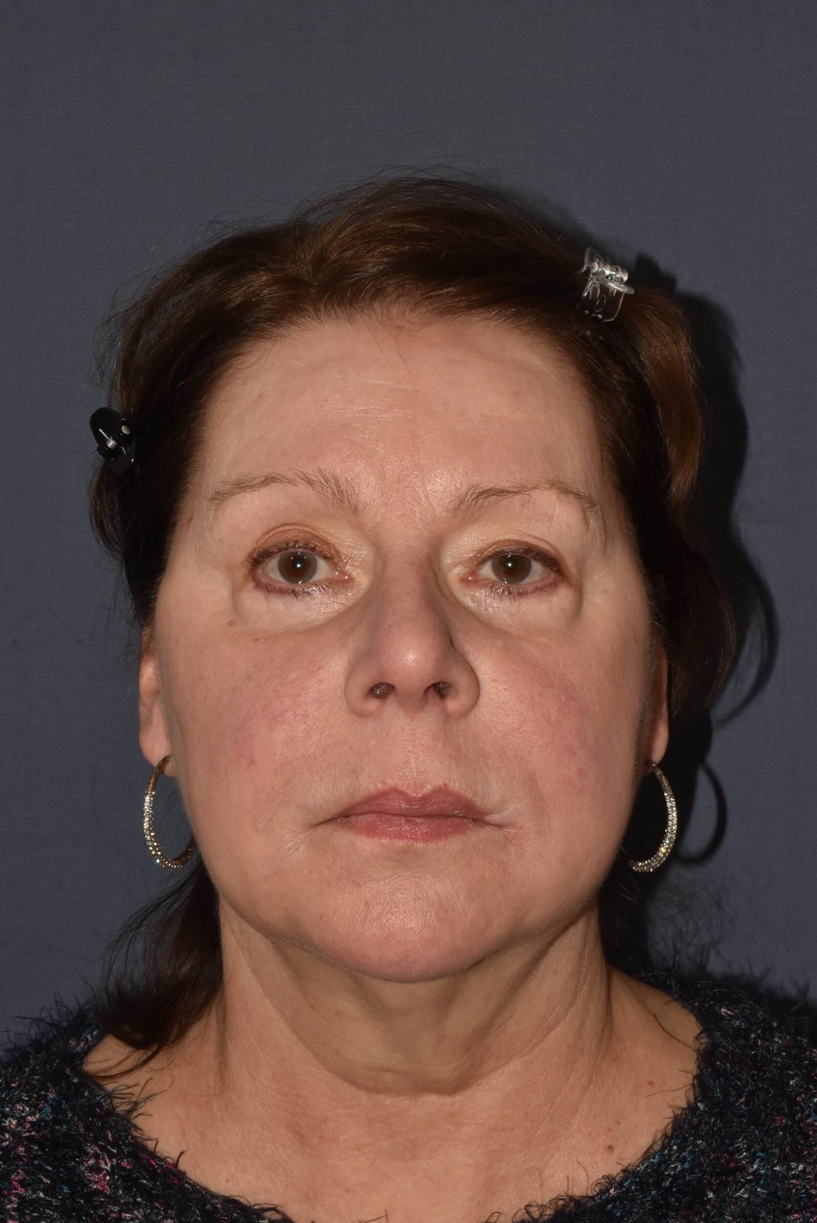 Before Image: Facial Rejuvenation – Lower Facelift / Neck Lift with Chin Implant - front