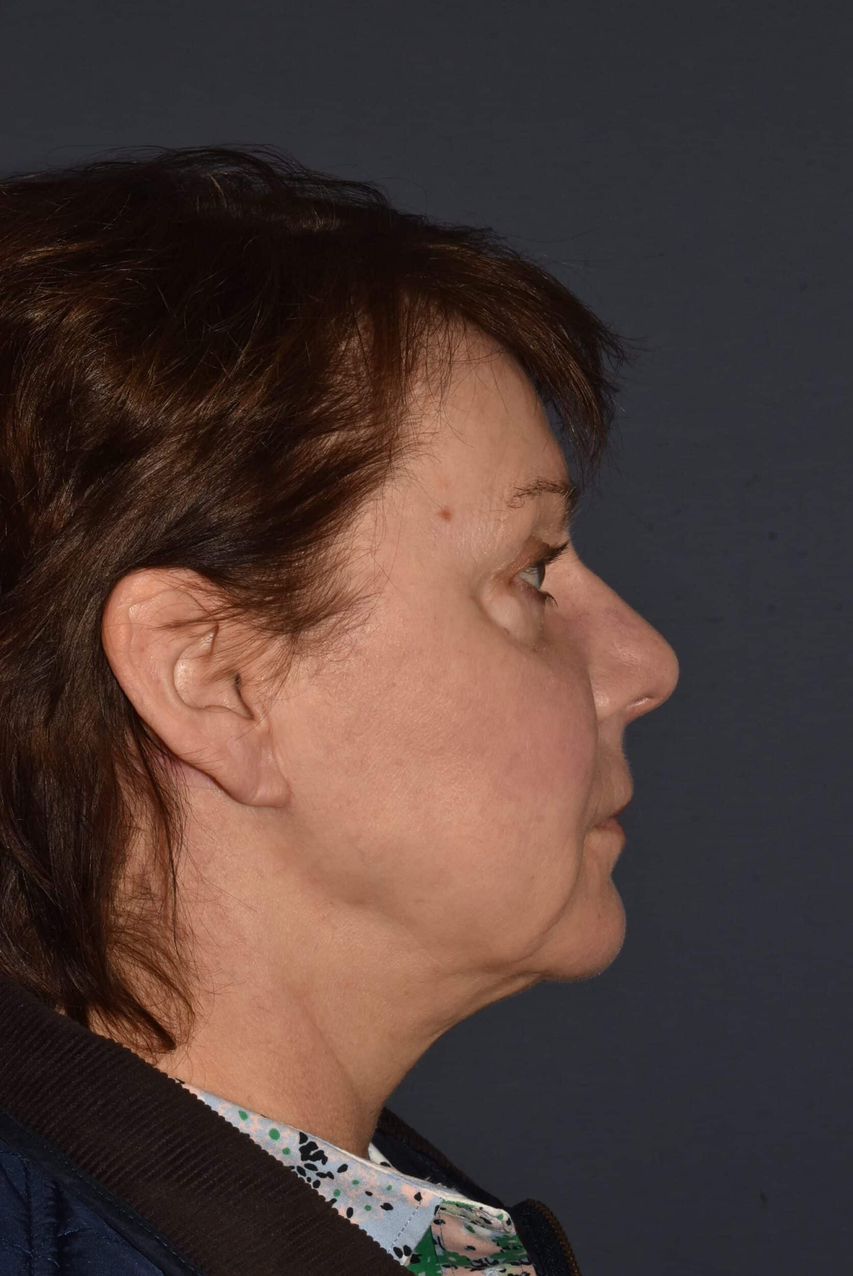 After Image: Facial Rejuvenation – Lower Facelift / Neck Lift with Chin Implant - right-side