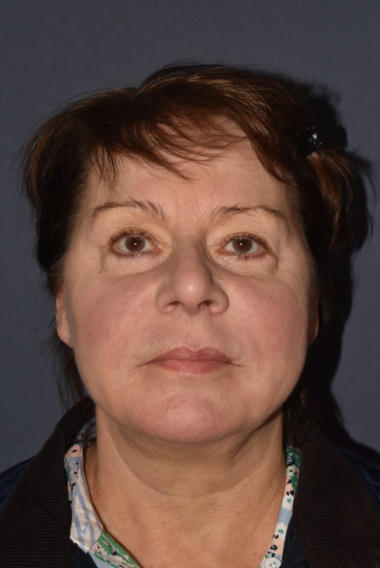 After Image: Facial Rejuvenation – Lower Facelift / Neck Lift with Chin Implant - front