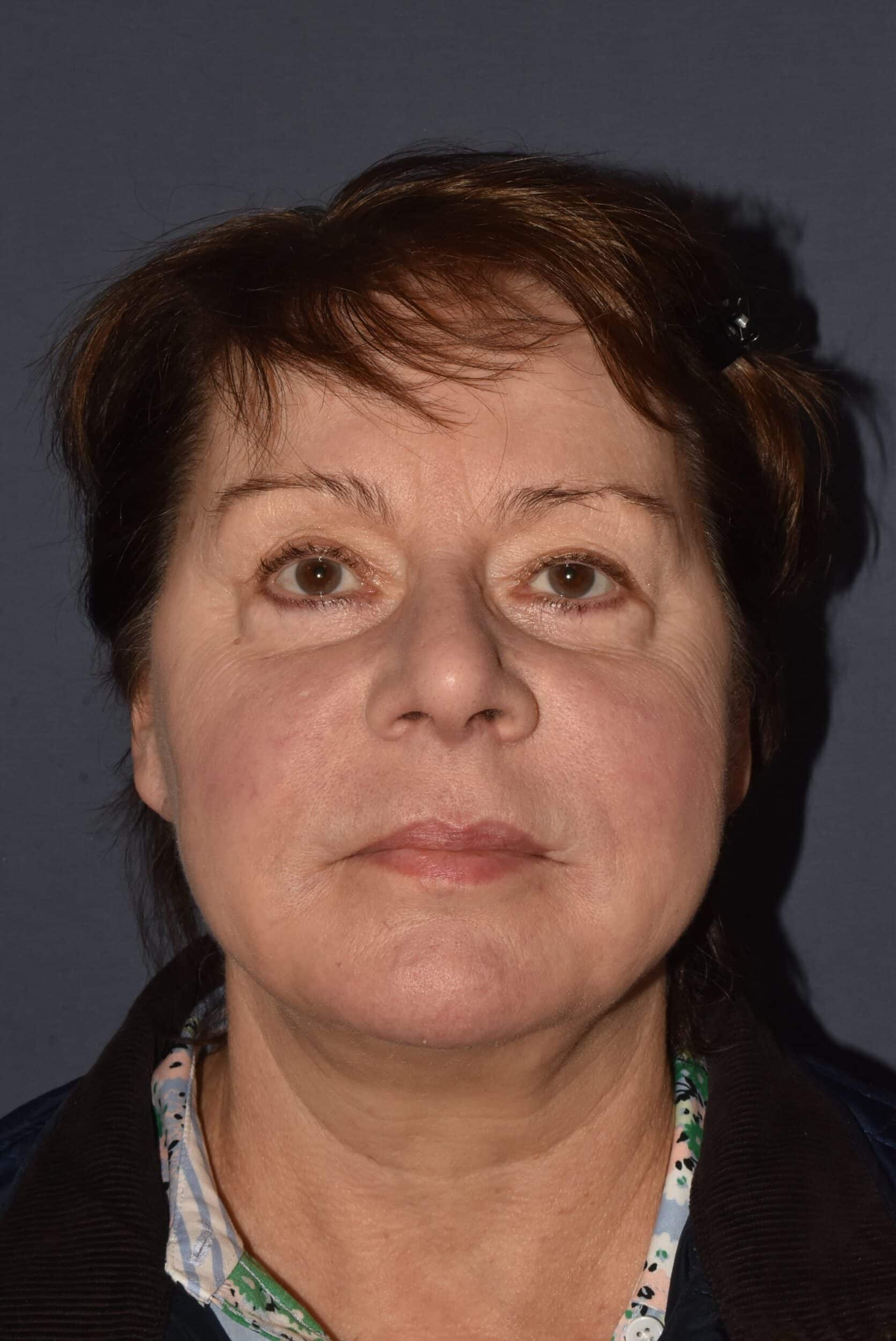 After Image: Facial Rejuvenation – Lower Facelift / Neck Lift with Chin Implant - front