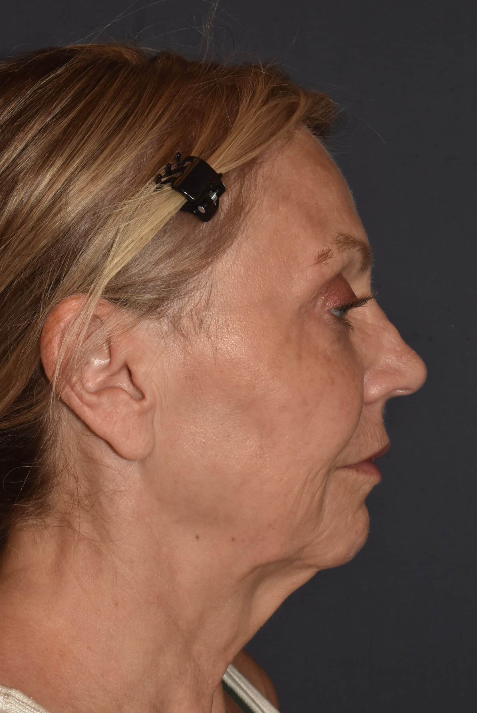 Before Image: Facial Rejuvenation – Lower Facelift / Neck Lift with Chin Implant Exchange - right-side