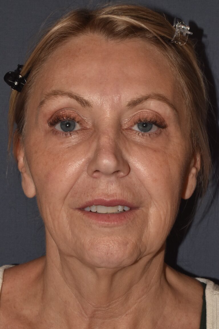 Before Image: Facial Rejuvenation – Lower Facelift / Neck Lift with Chin Implant Exchange - front