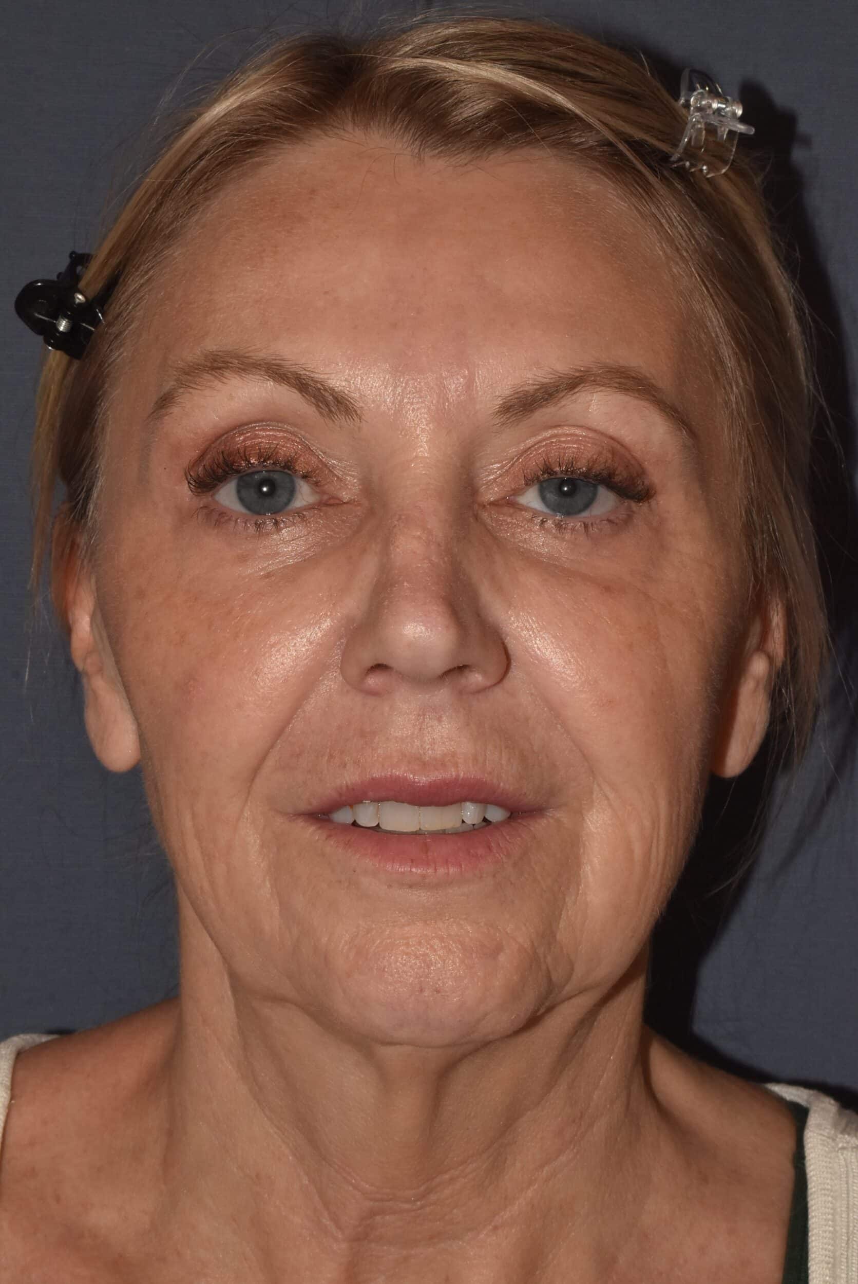 Before Image: Facial Rejuvenation – Lower Facelift / Neck Lift with Chin Implant Exchange - front