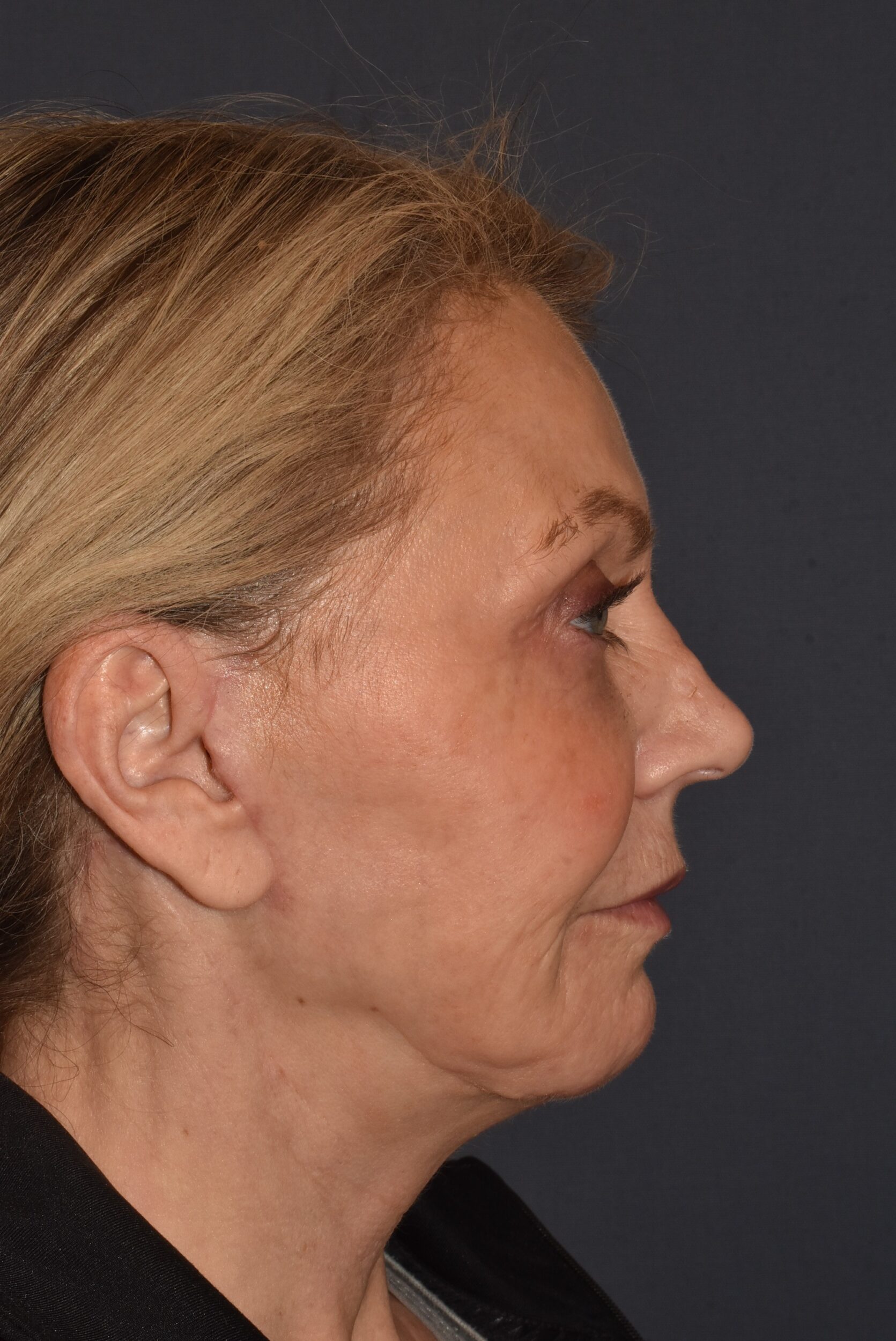 After Image: Facial Rejuvenation – Lower Facelift / Neck Lift with Chin Implant Exchange - right-side