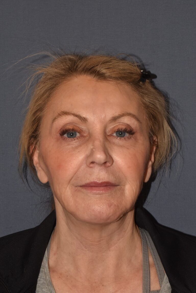 After Image: Facial Rejuvenation – Lower Facelift / Neck Lift with Chin Implant Exchange - front