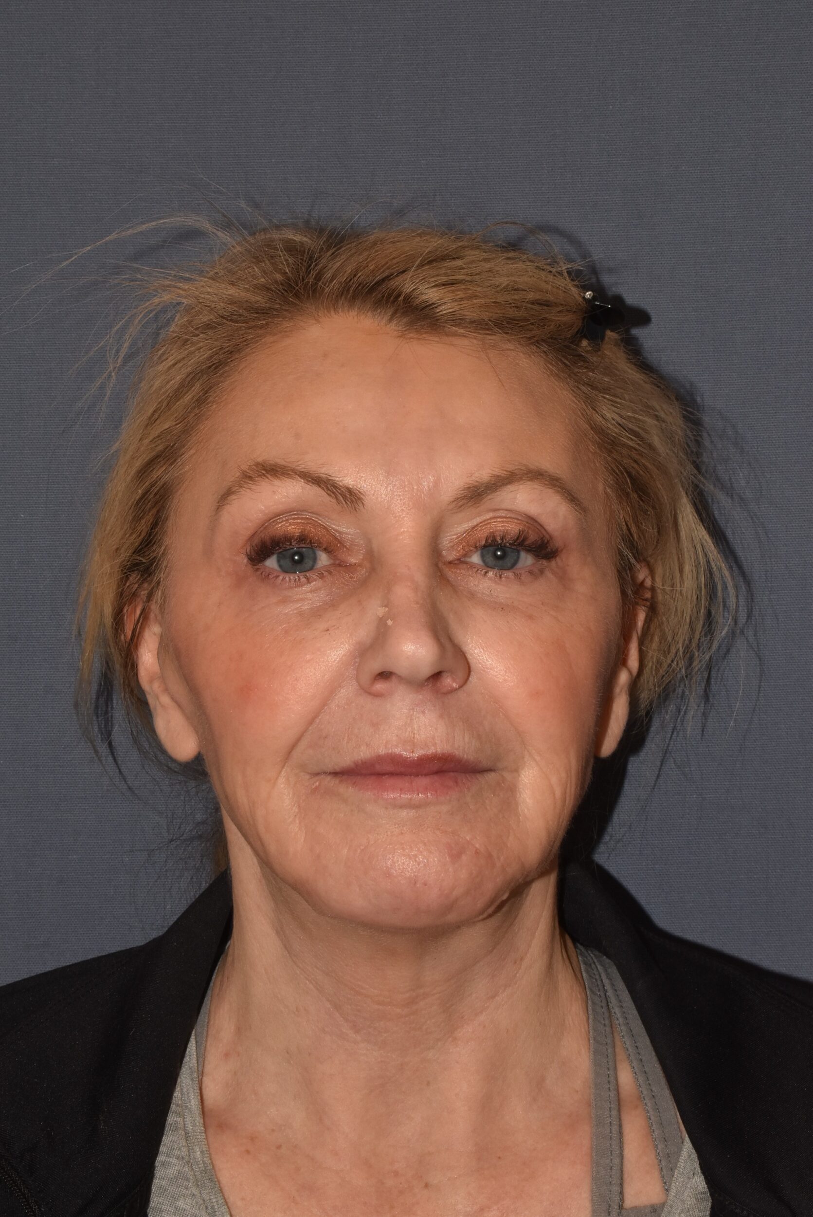 After Image: Facial Rejuvenation – Lower Facelift / Neck Lift with Chin Implant Exchange - front