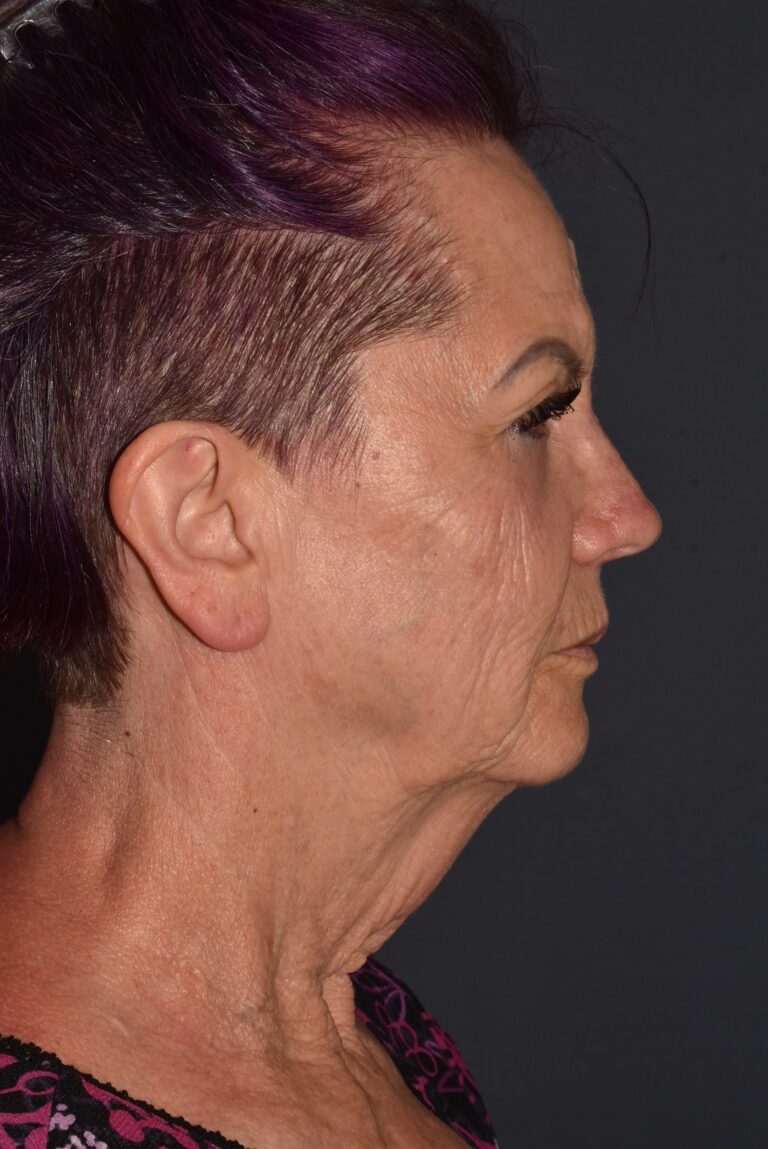 Before Image: Facial Rejuvenation – Lower Facelift / Neck Lift with Chin Implant and Modified Brow Lift - right-side