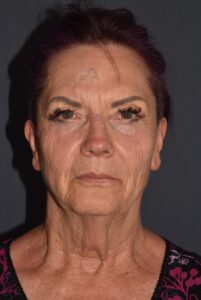 Before Image: Facial Rejuvenation – Lower Facelift / Neck Lift with Chin Implant and Modified Brow Lift