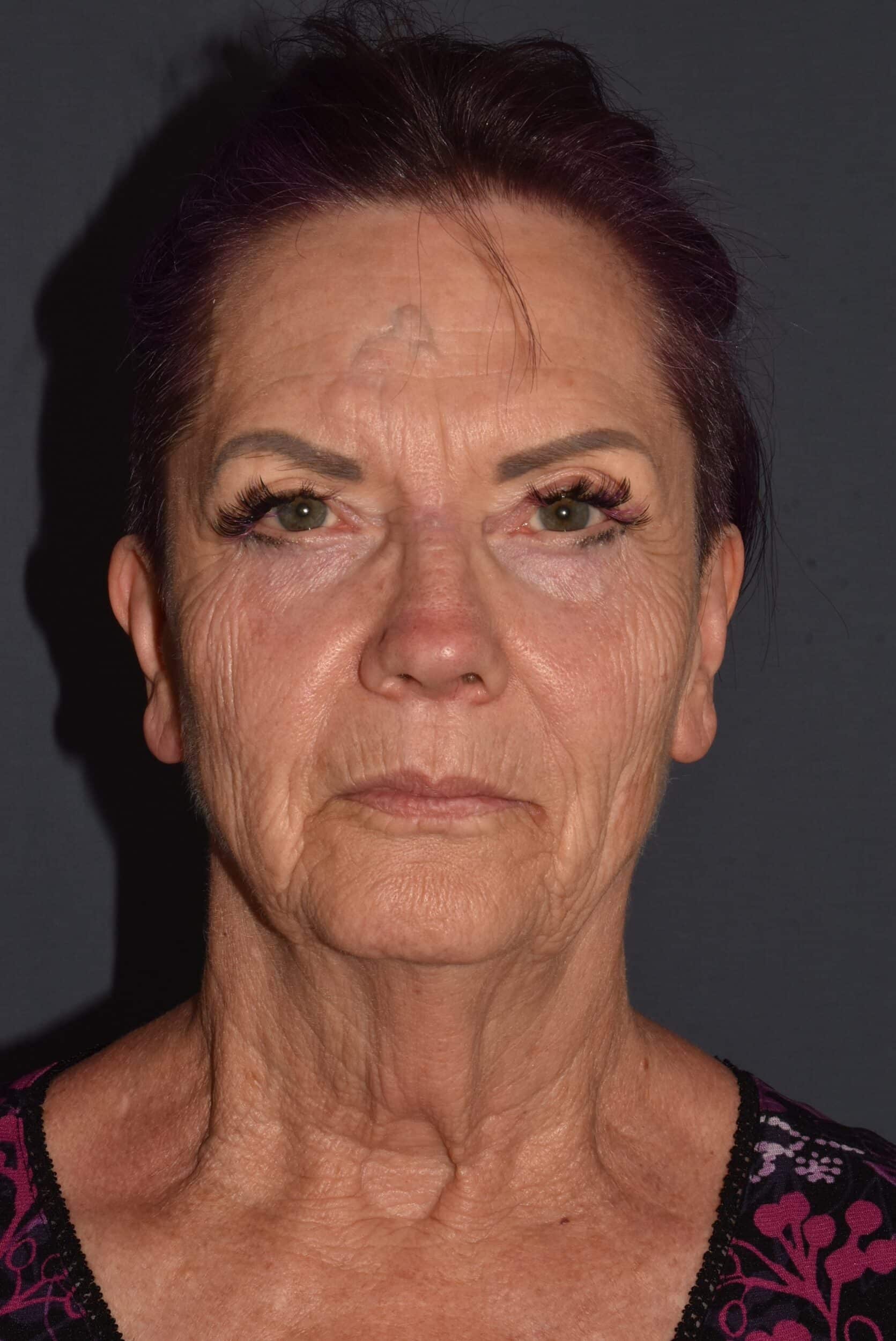 Before Image: Facial Rejuvenation – Lower Facelift / Neck Lift with Chin Implant and Modified Brow Lift - front