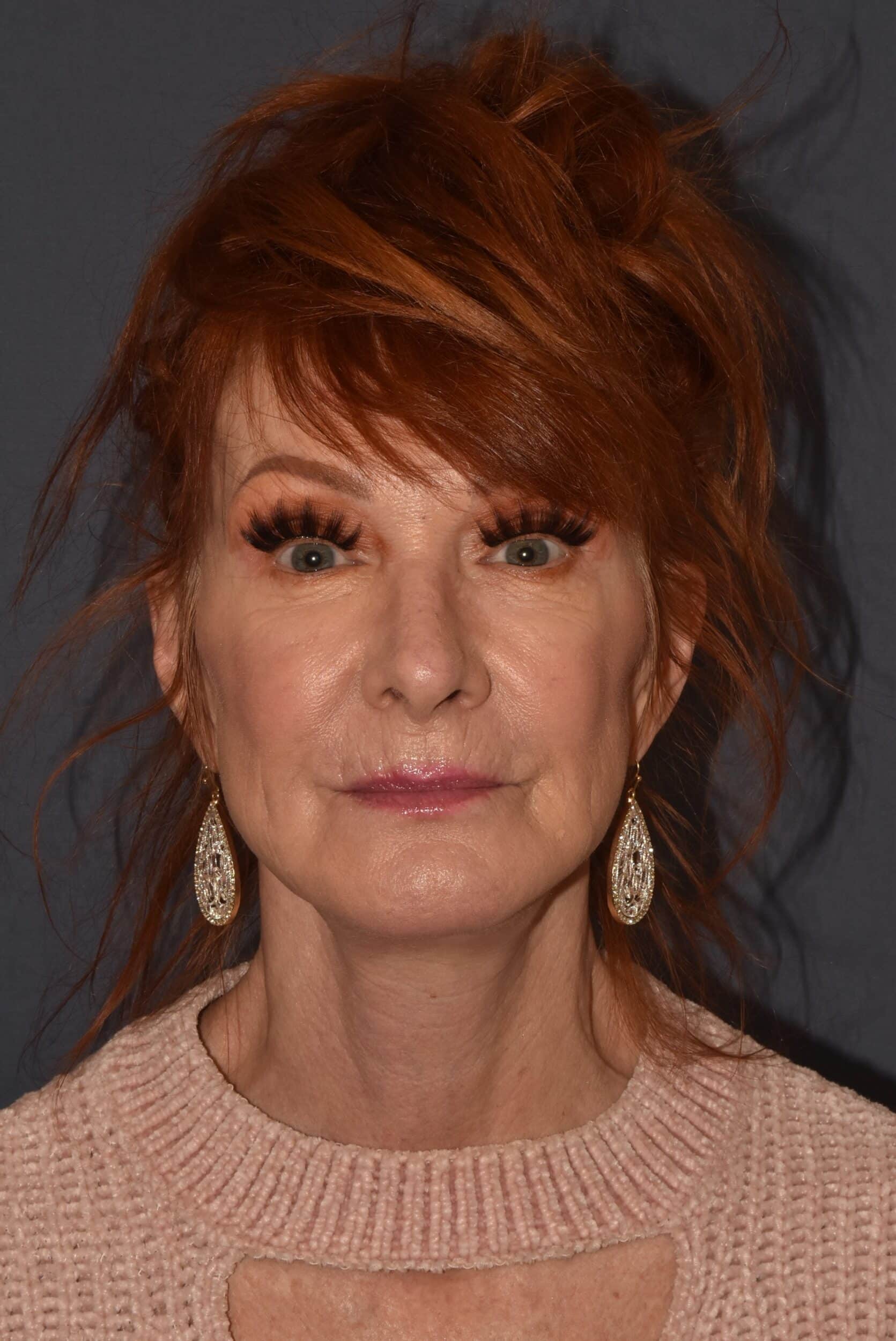 After Image: Facial Rejuvenation – Lower Facelift / Neck Lift with Chin Implant - front