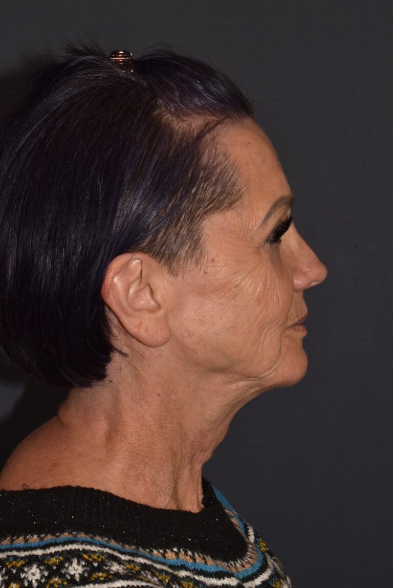 After Image: Facial Rejuvenation – Lower Facelift / Neck Lift with Chin Implant and Modified Brow Lift - right-side