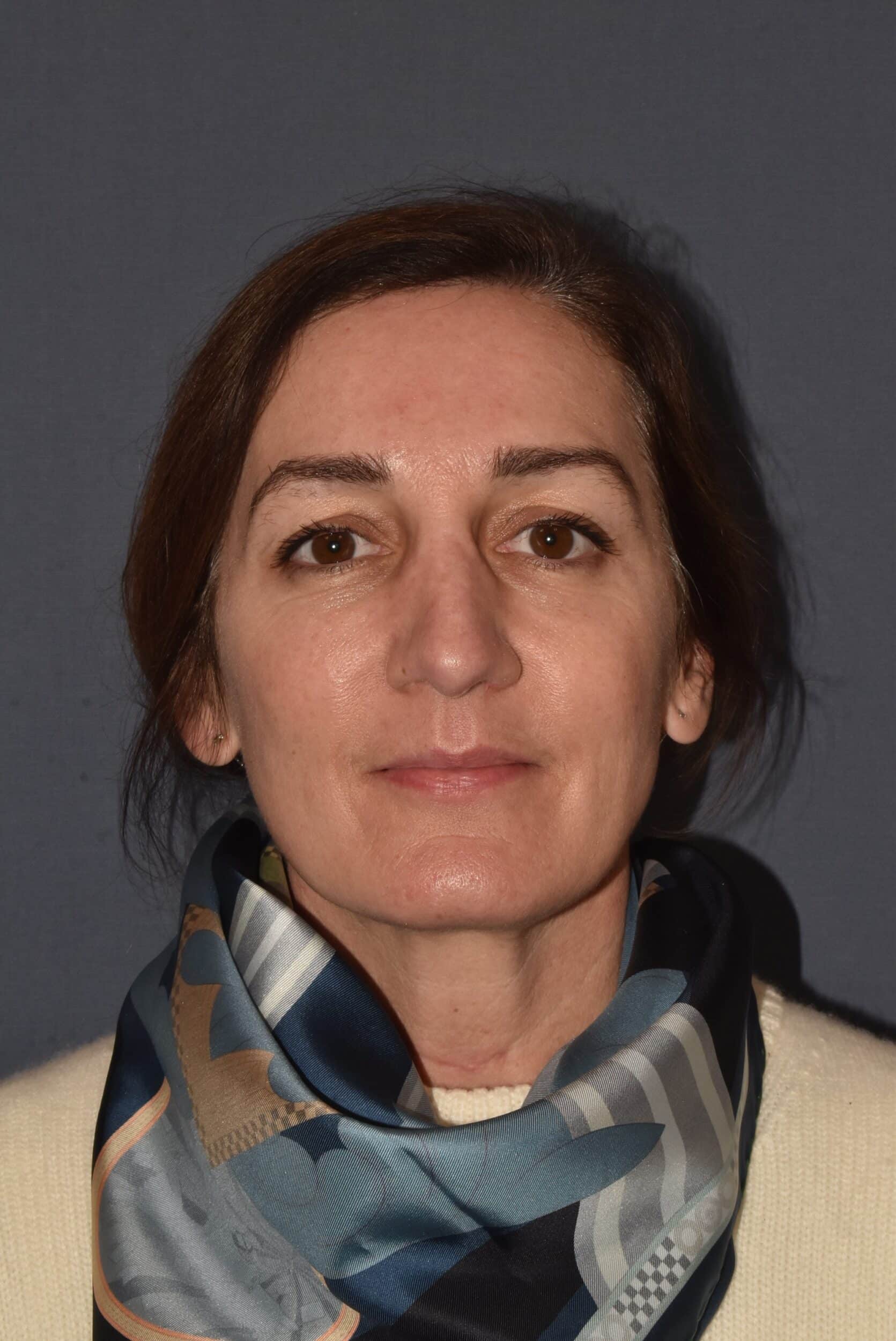 After Image: Rhinoplasty – Open - 