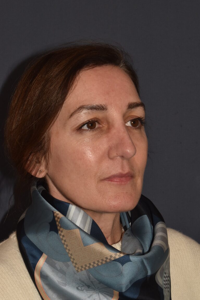 After Image: Rhinoplasty – Open -