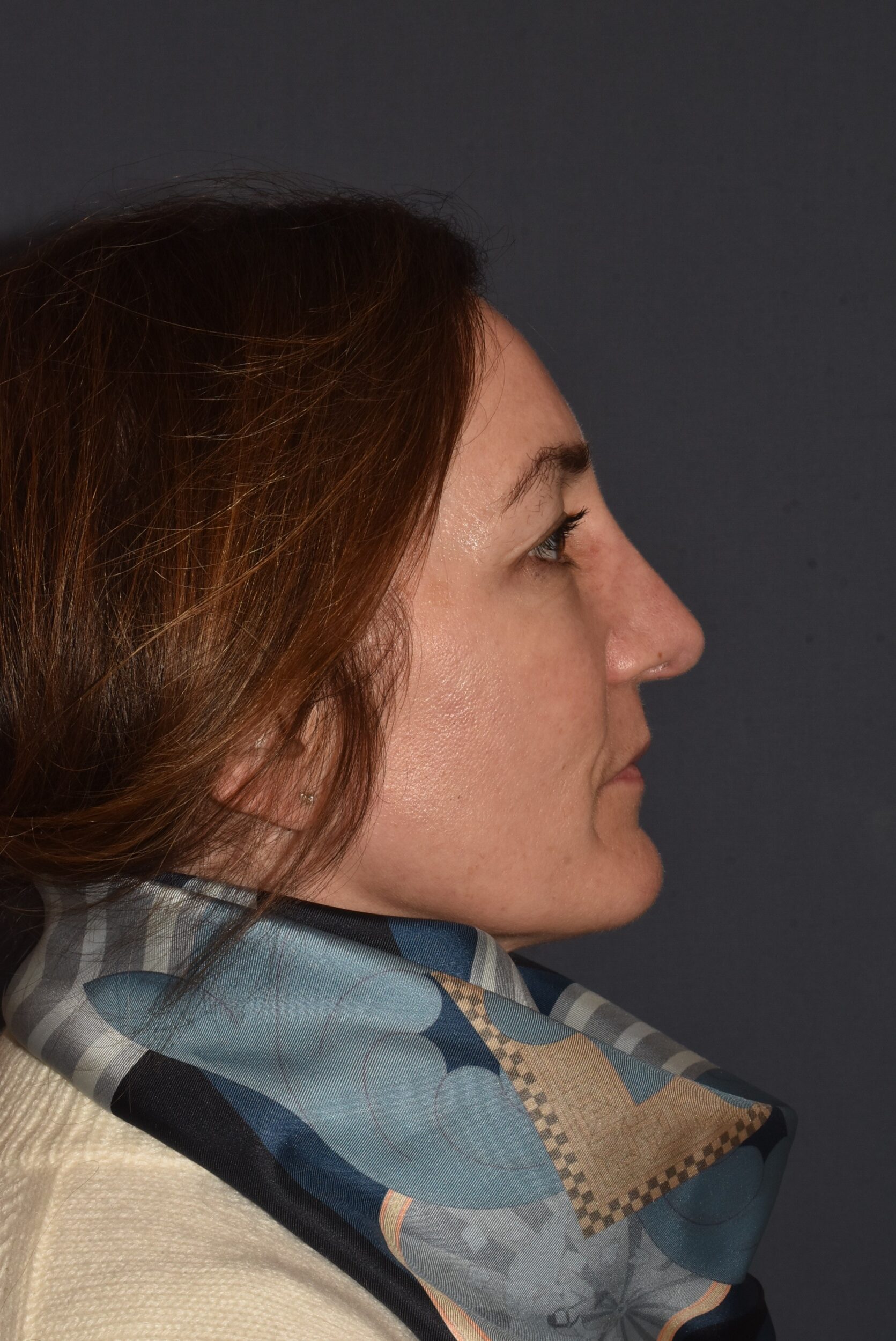 After Image: Rhinoplasty – Open - right-side