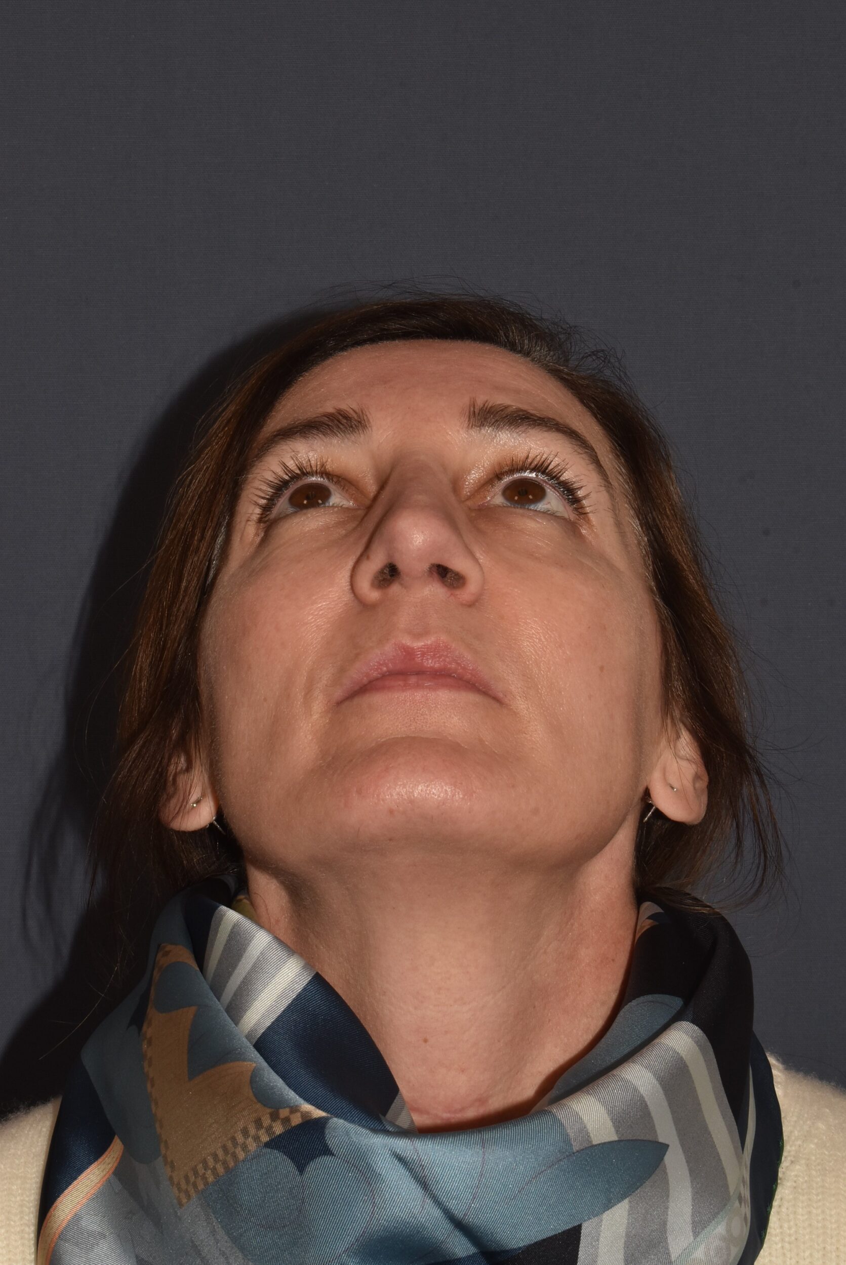 After Image: Rhinoplasty – Open - other