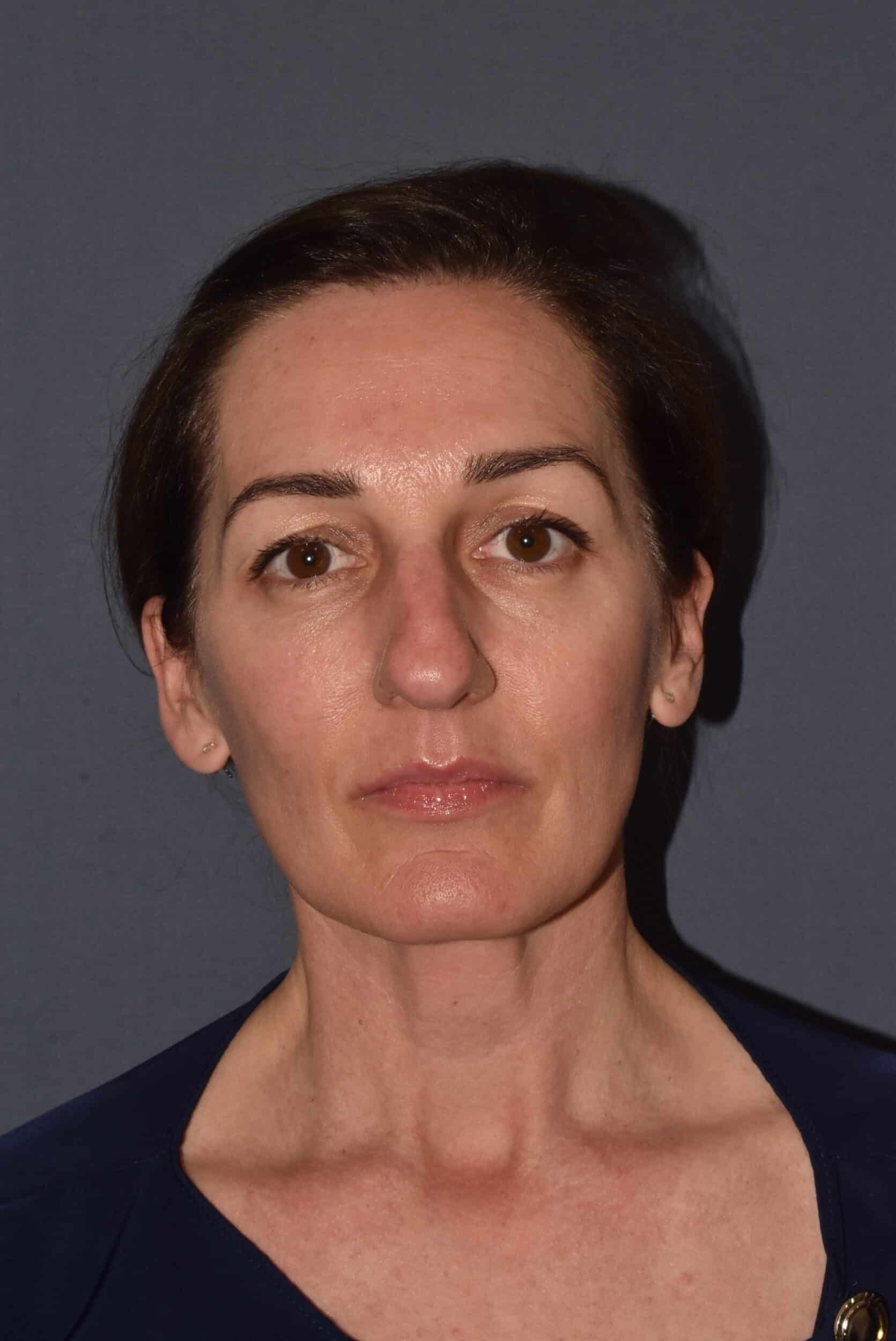 Before Image: Rhinoplasty – Open - 