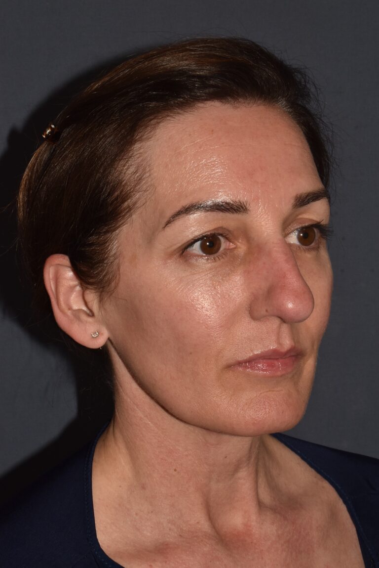 Before Image: Rhinoplasty – Open -