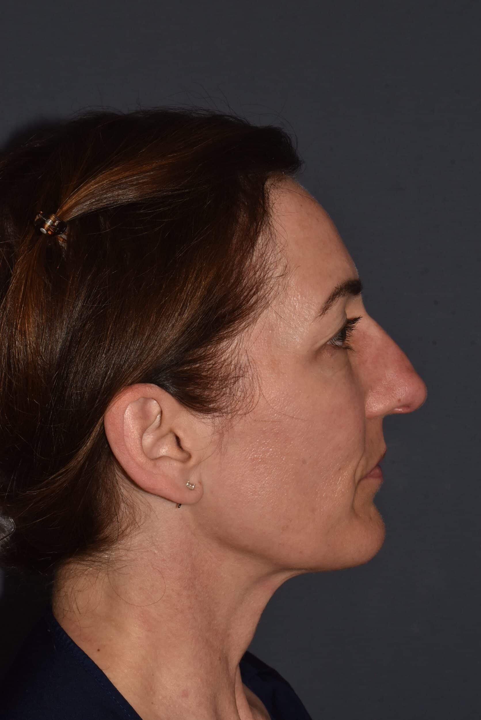 Before Image: Rhinoplasty – Open - right-side