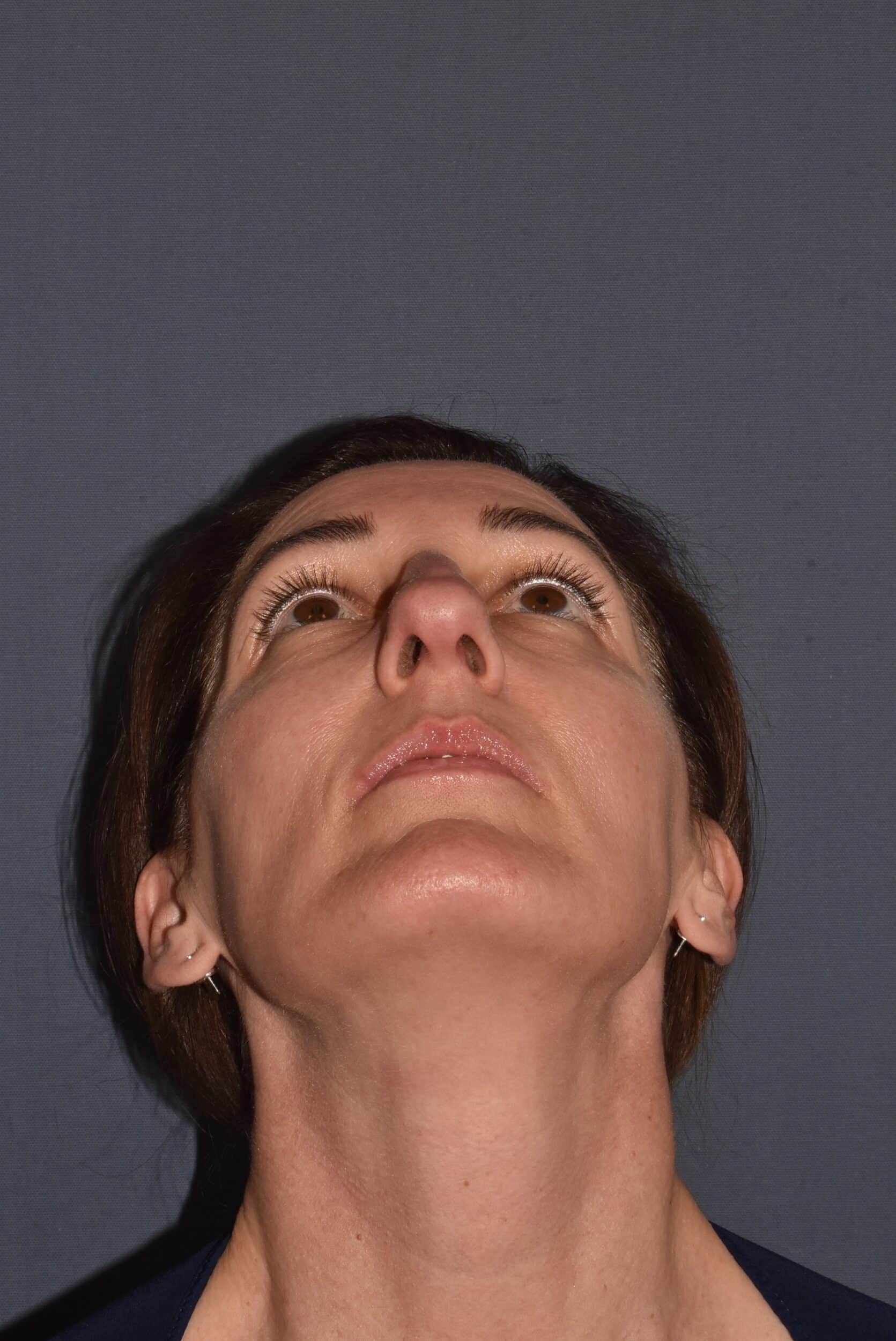 Before Image: Rhinoplasty – Open - other