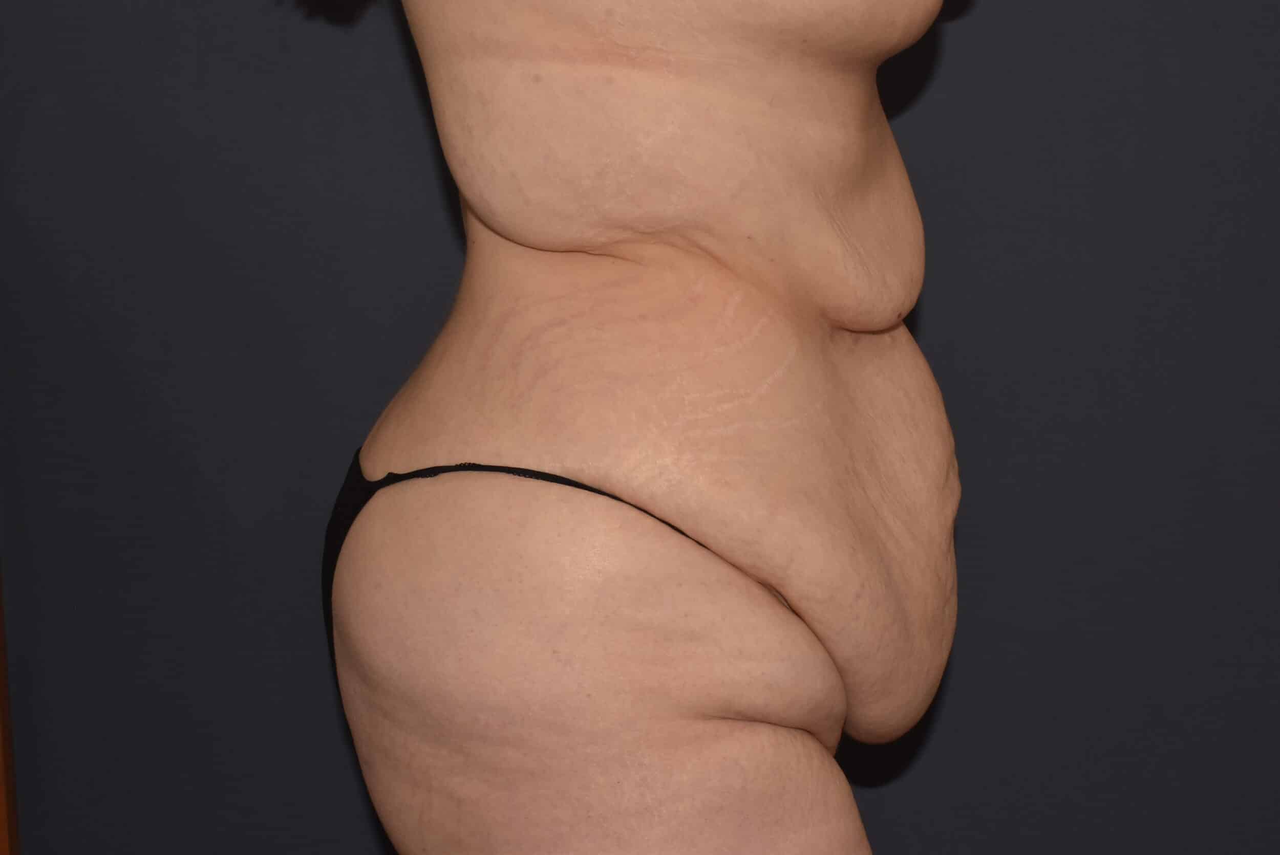 Before Image: Massive Weight Loss – Abdominoplasty plus Reverse Abdominoplasty - right-side