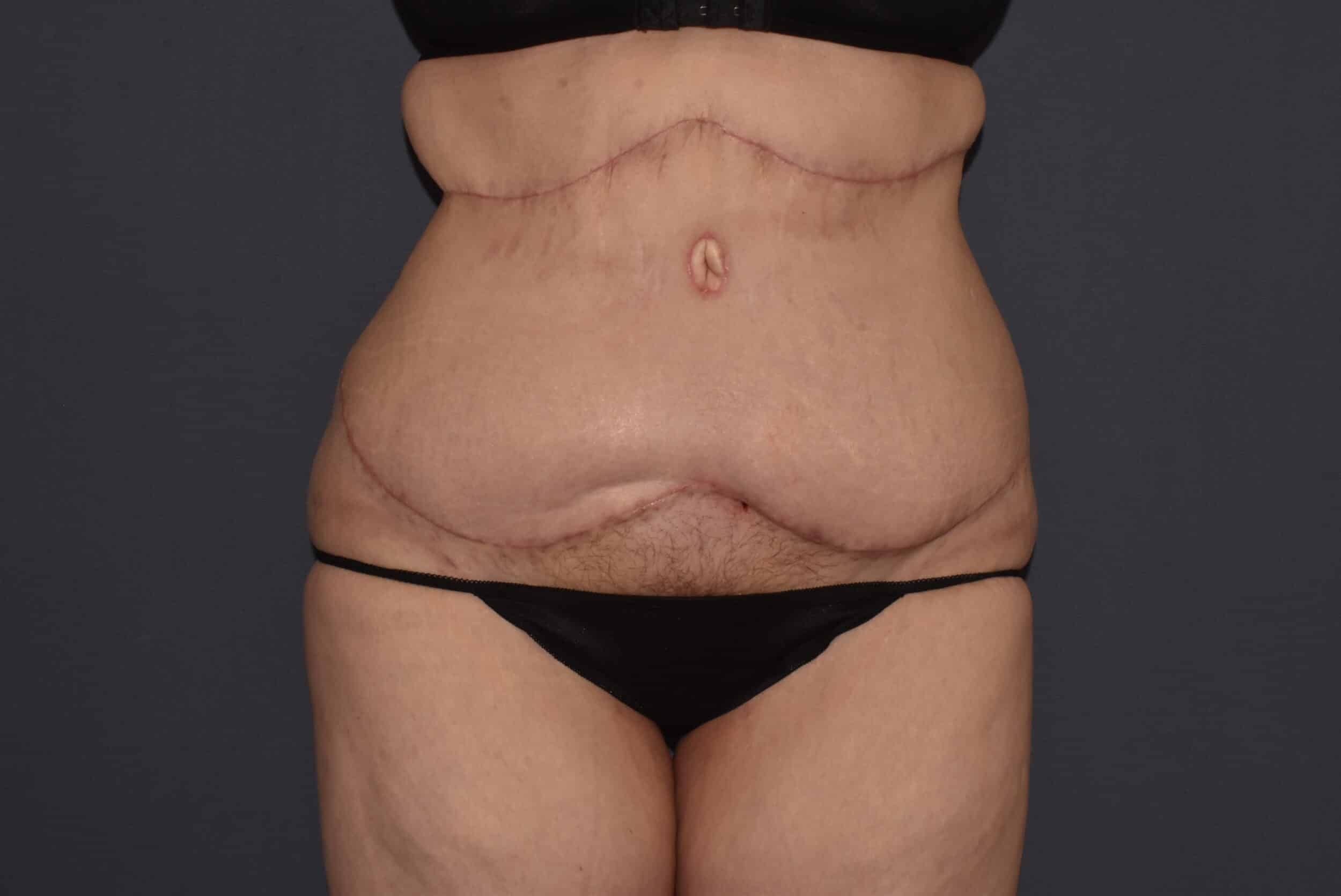 After Image: Massive Weight Loss – Abdominoplasty plus Reverse Abdominoplasty - front