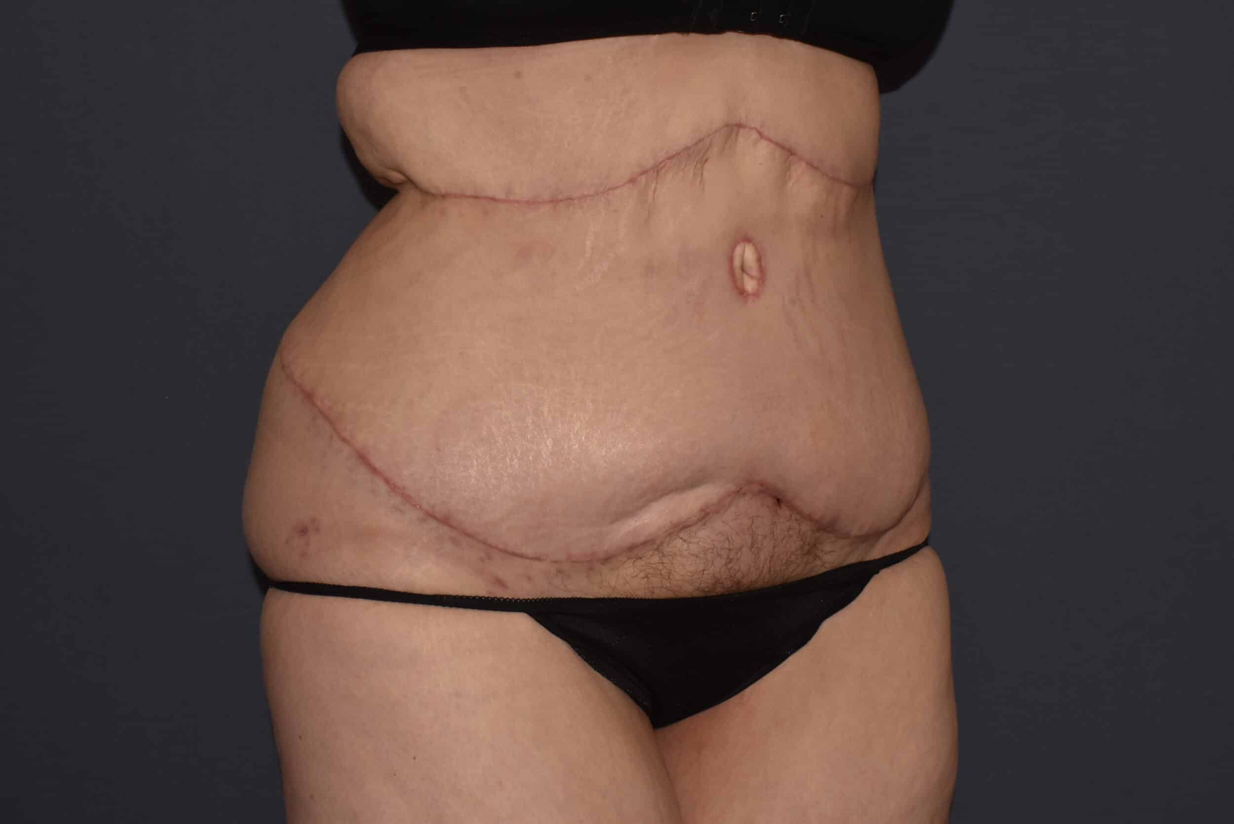 After Image: Massive Weight Loss – Abdominoplasty plus Reverse Abdominoplasty - right-front-oblique