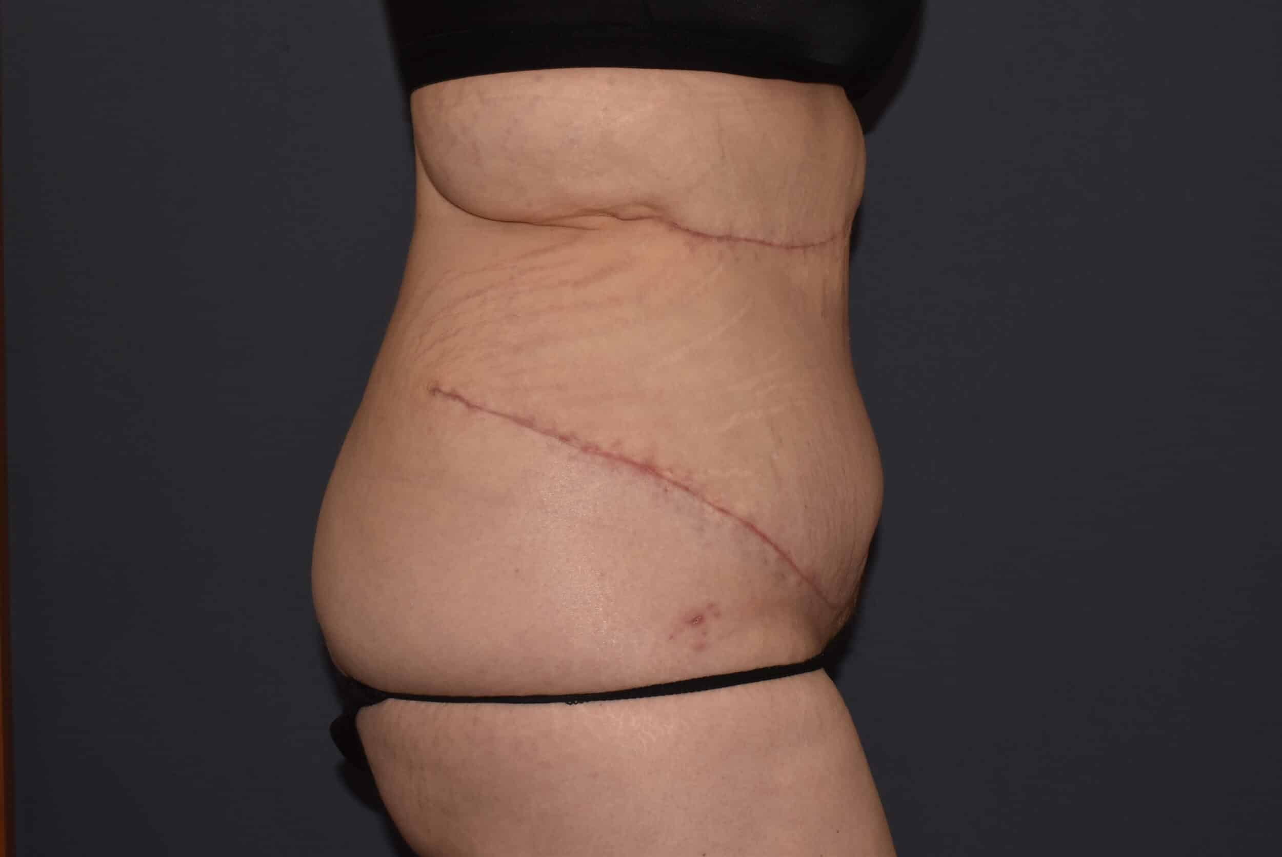 After Image: Massive Weight Loss – Abdominoplasty plus Reverse Abdominoplasty - right-side