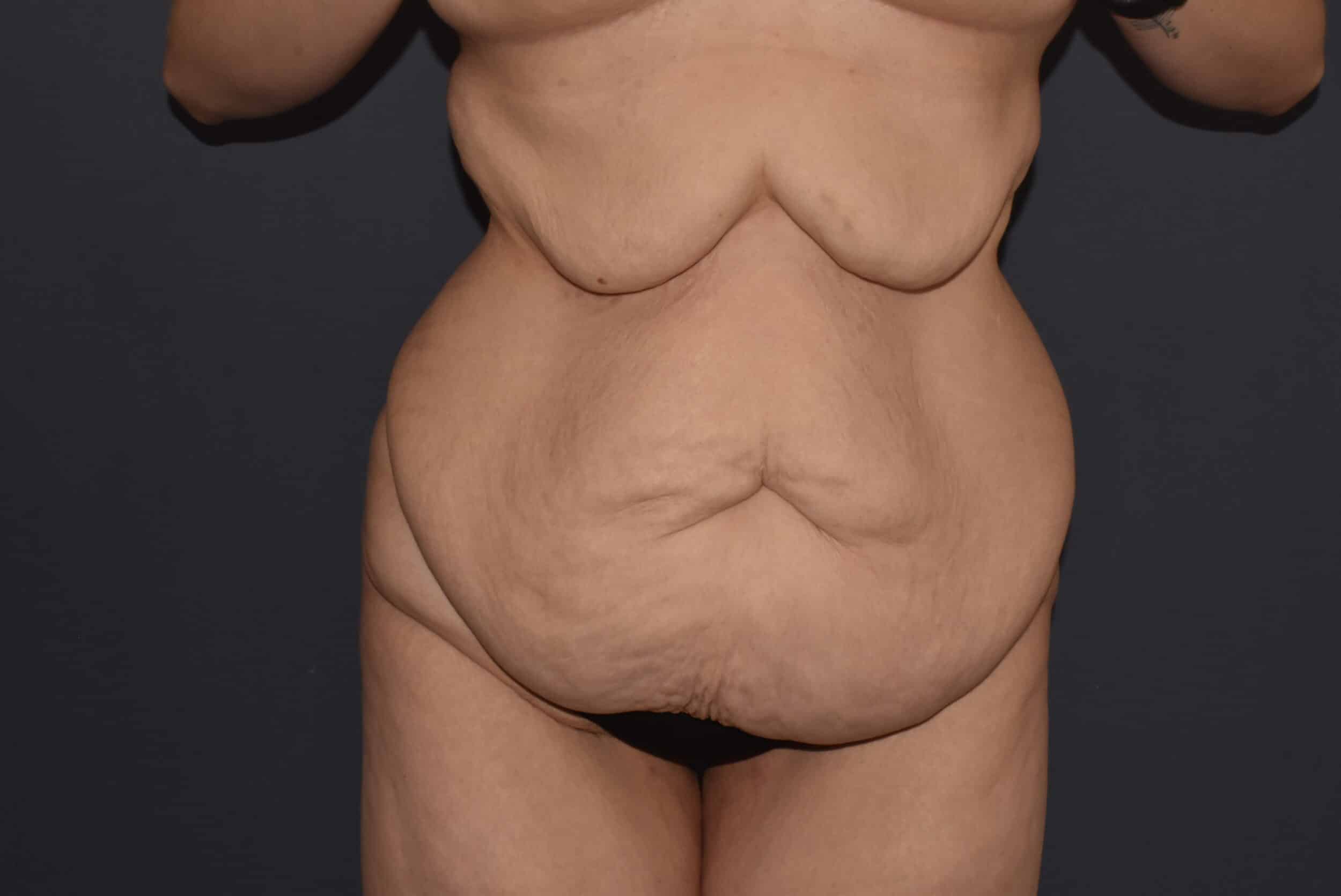 Before Image: Massive Weight Loss – Abdominoplasty plus Reverse Abdominoplasty - front