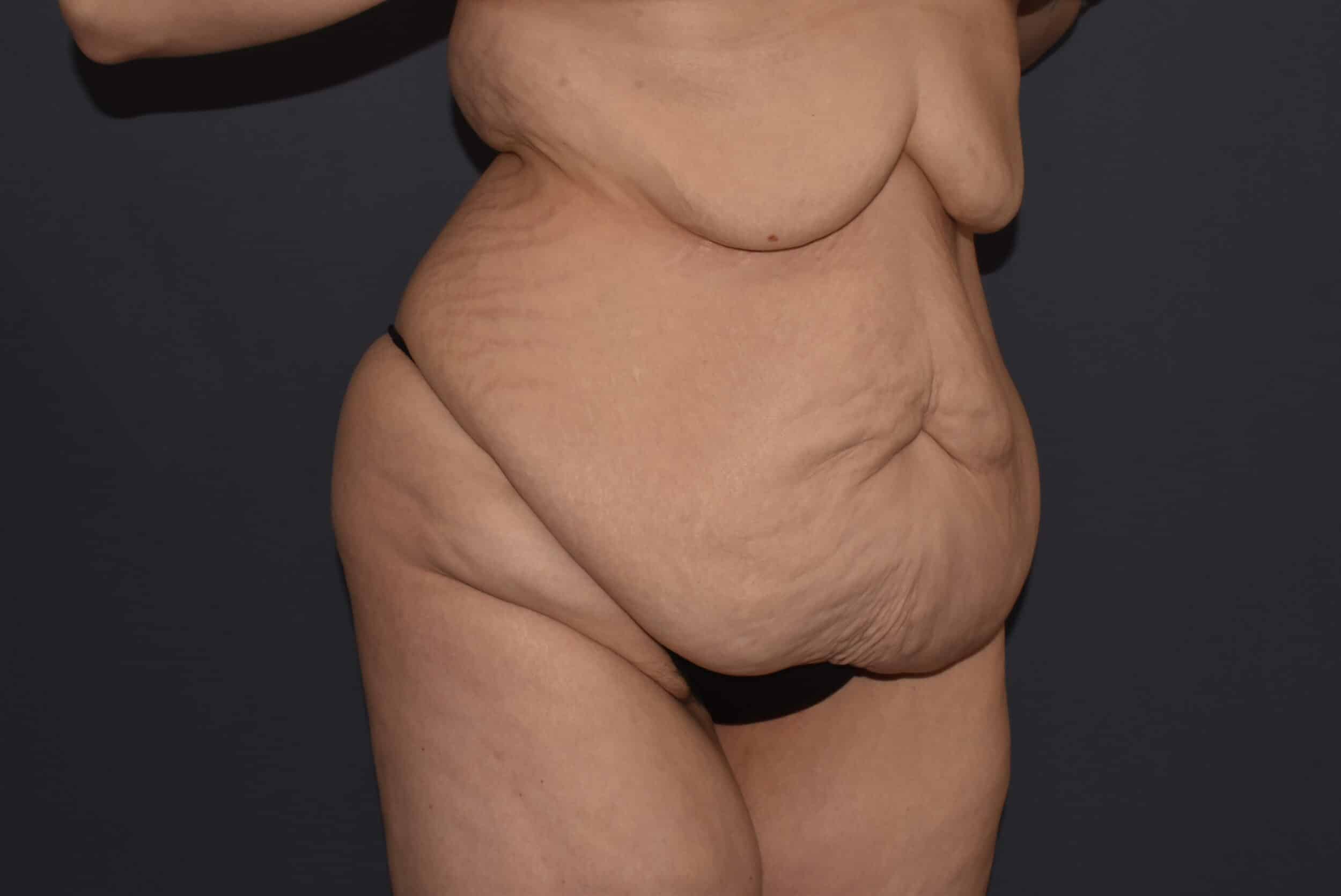 Before Image: Massive Weight Loss – Abdominoplasty plus Reverse Abdominoplasty - right-front-oblique