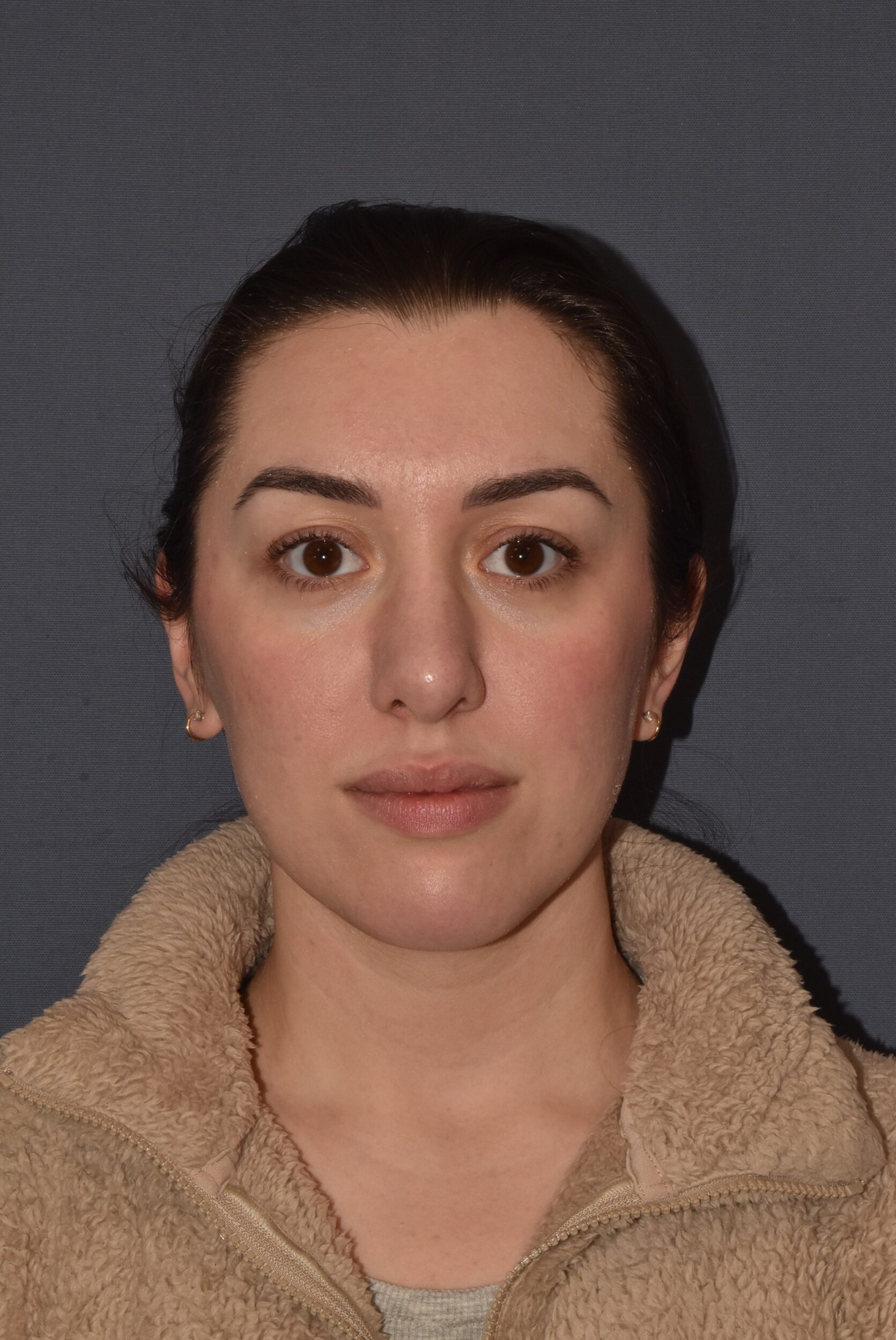 After Image: Rhinoplasty – Open - front