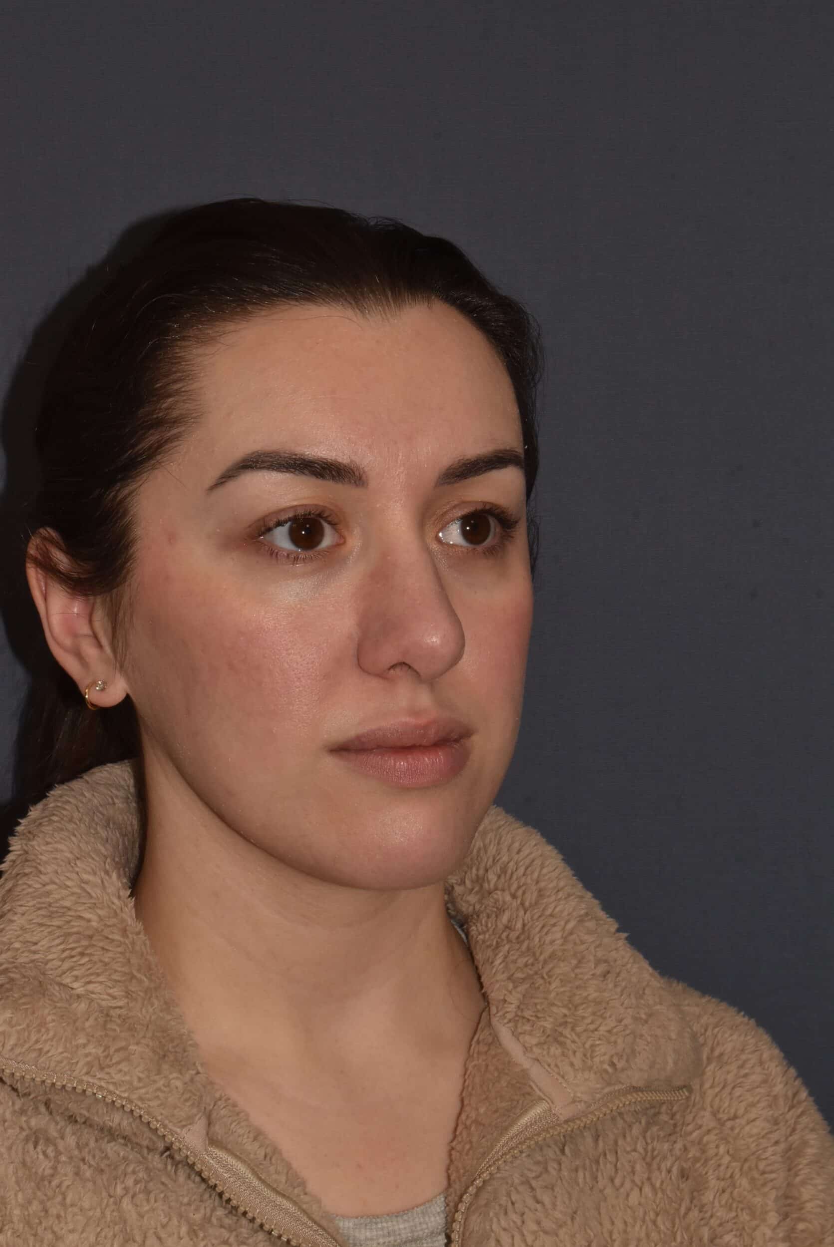 After Image: Rhinoplasty – Open - right-front-oblique